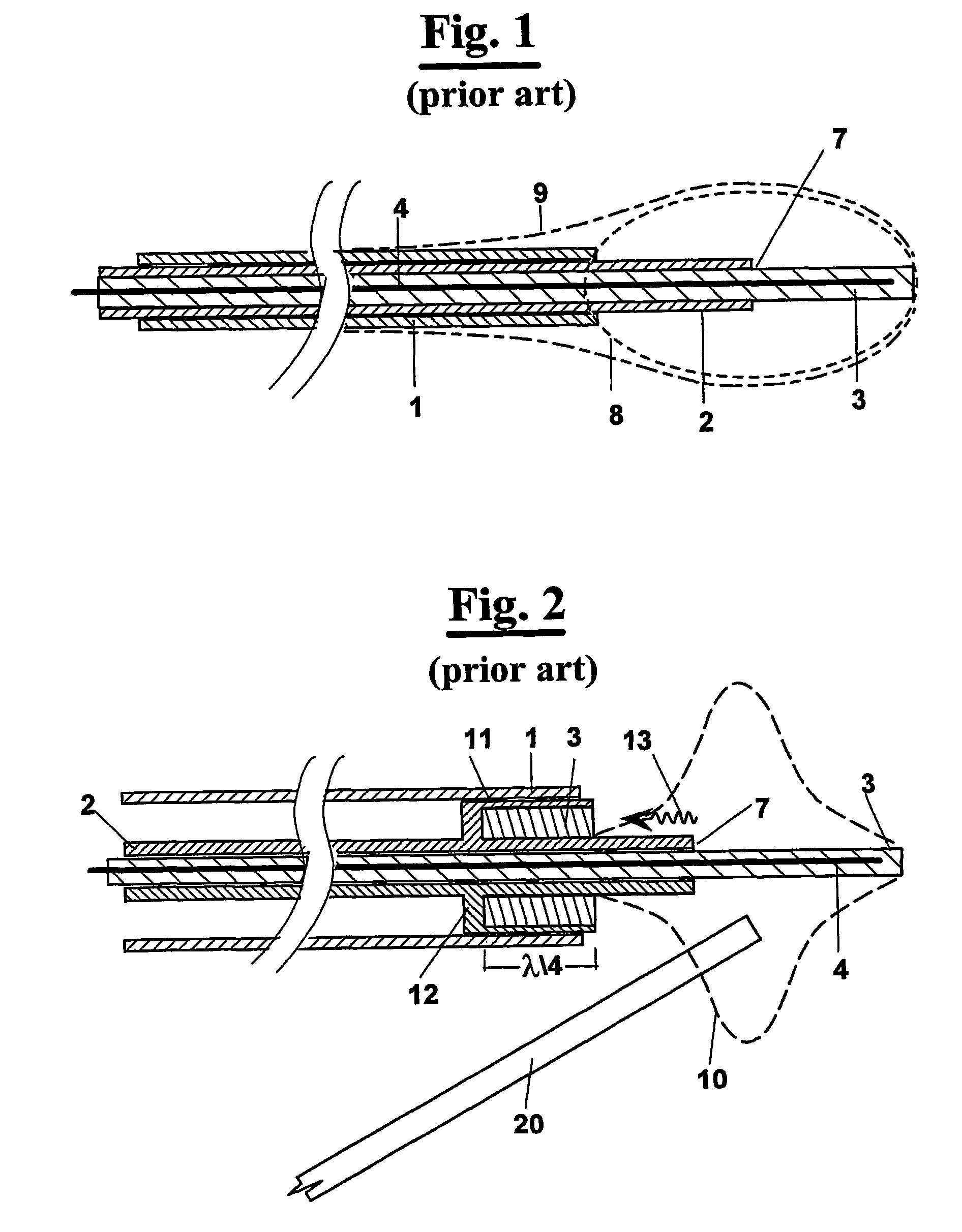 Interstitial microwave antenna with miniaturized choke hyperthermia in medicine and surgery