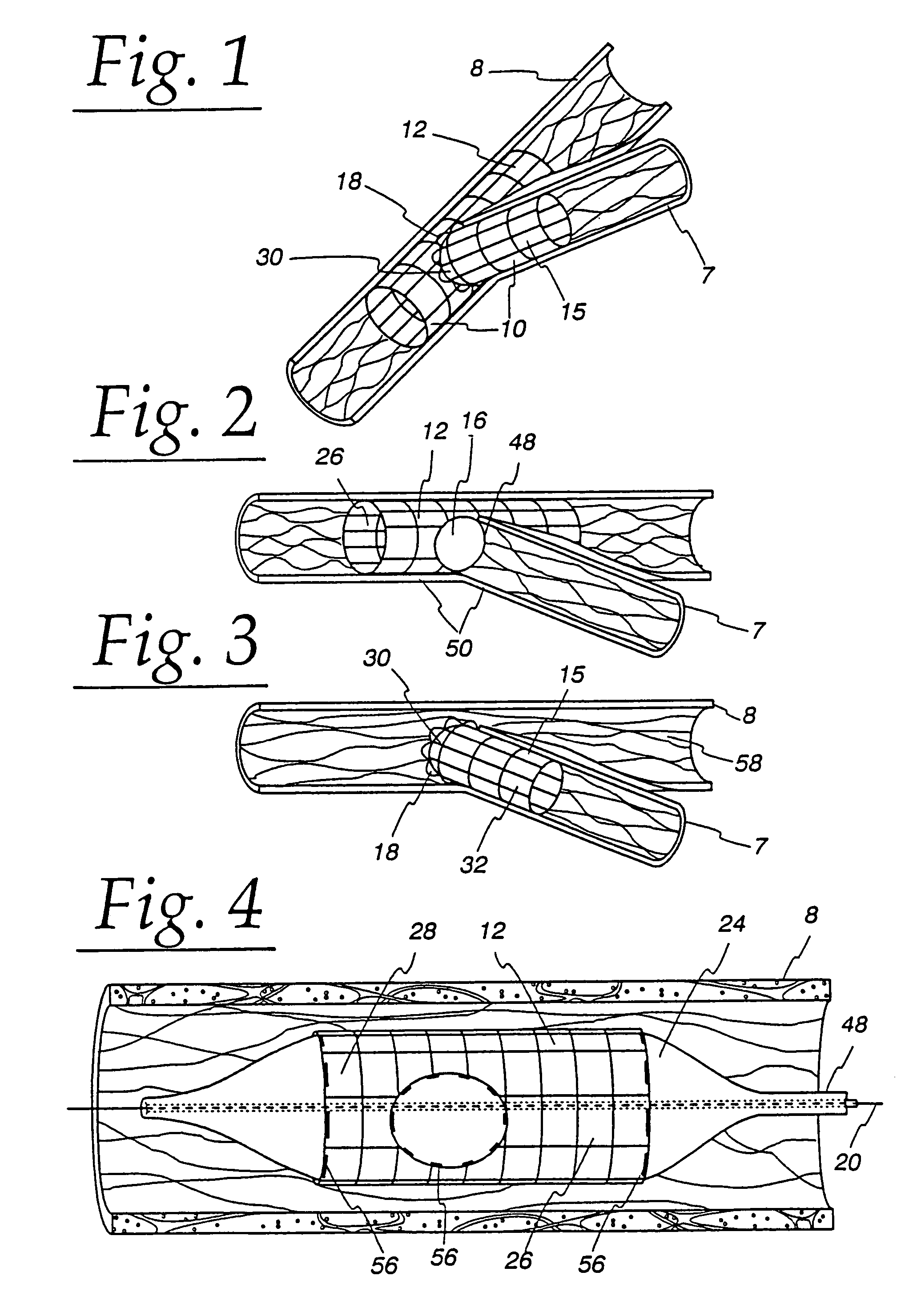 Extendible stent apparatus