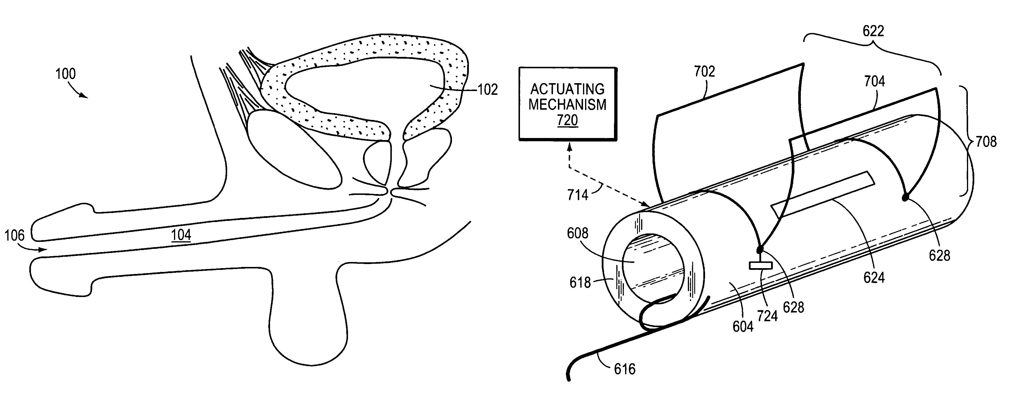 Stricture retractor