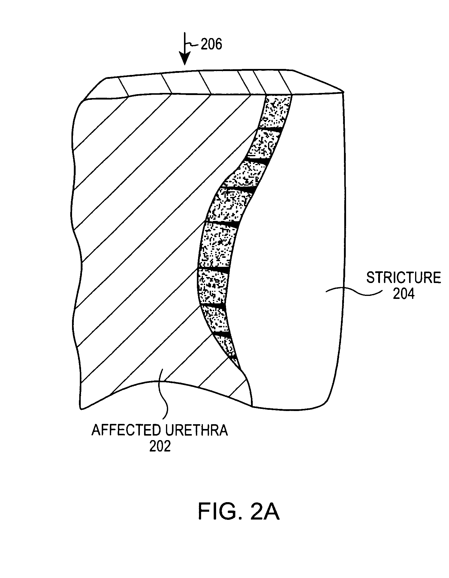 Stricture retractor