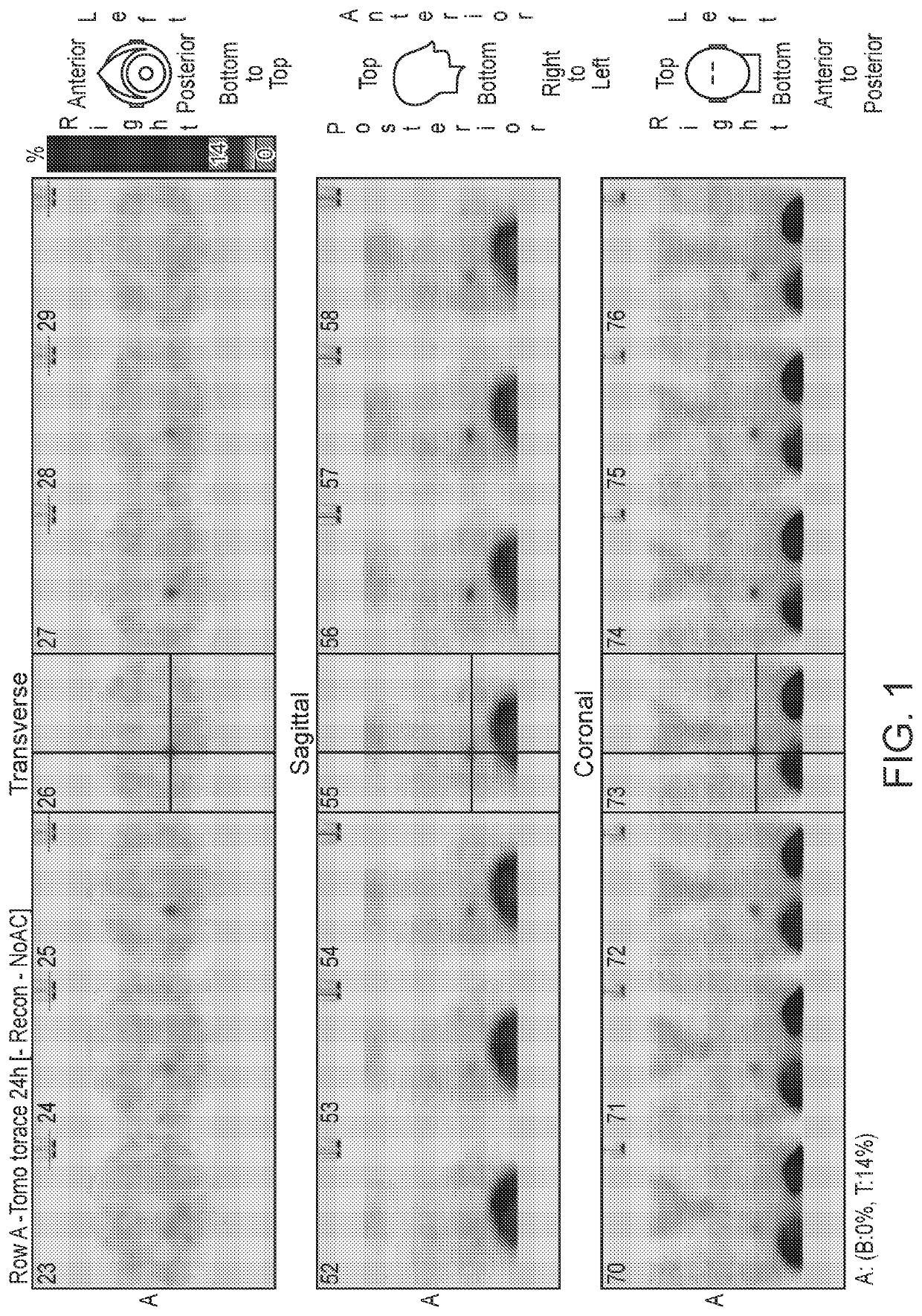 Methods for Imaging and Treatment of Somatostatin-Receptor Positive Tumors