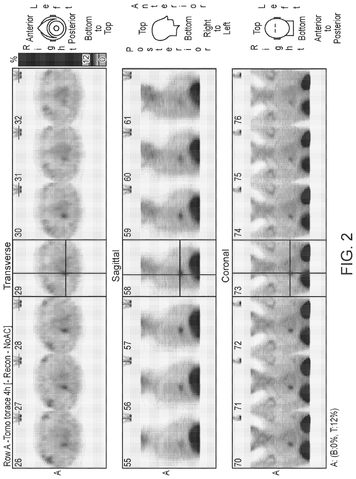 Methods for Imaging and Treatment of Somatostatin-Receptor Positive Tumors