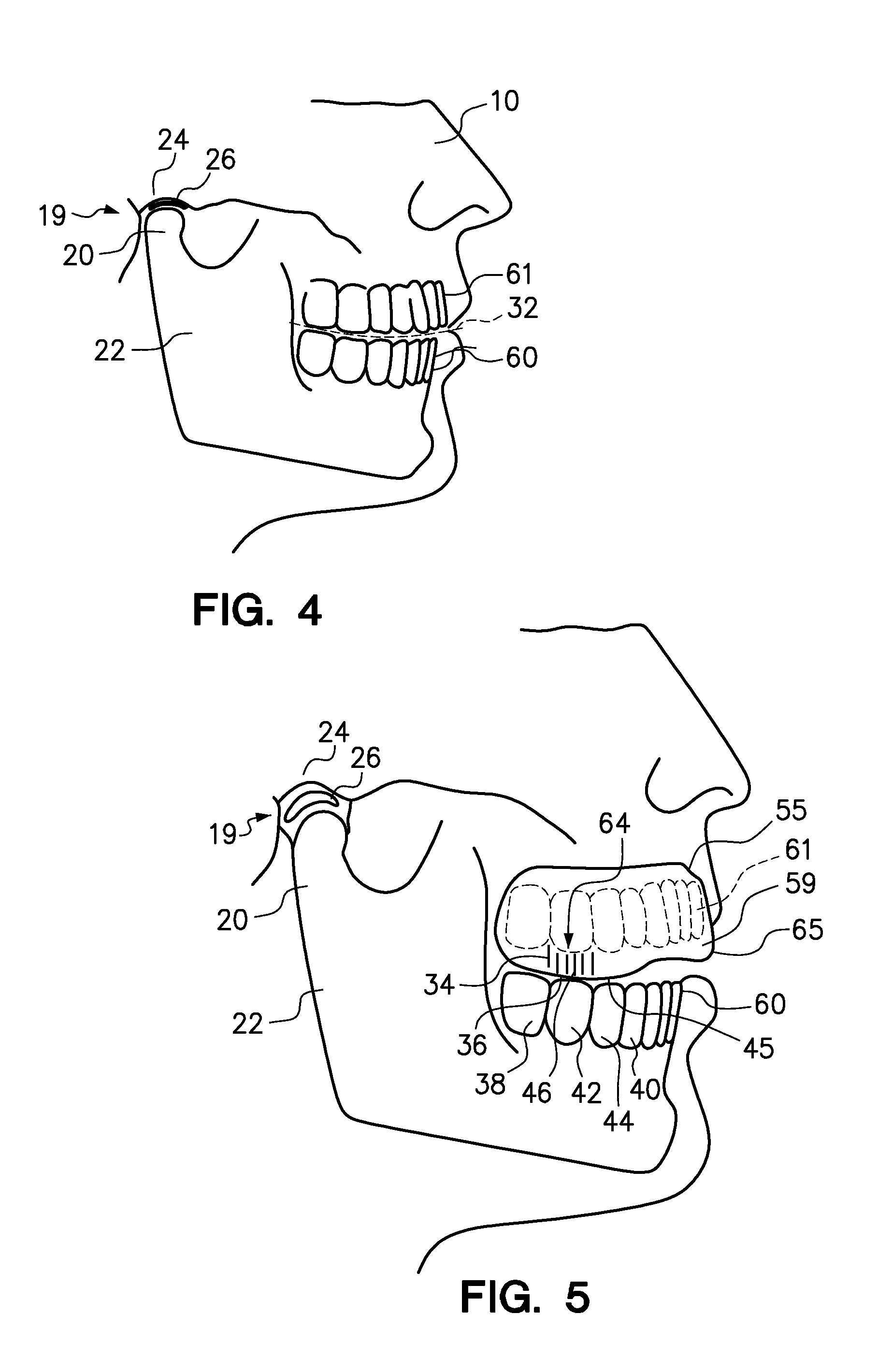 Mouthguard and method of manufacture therefor