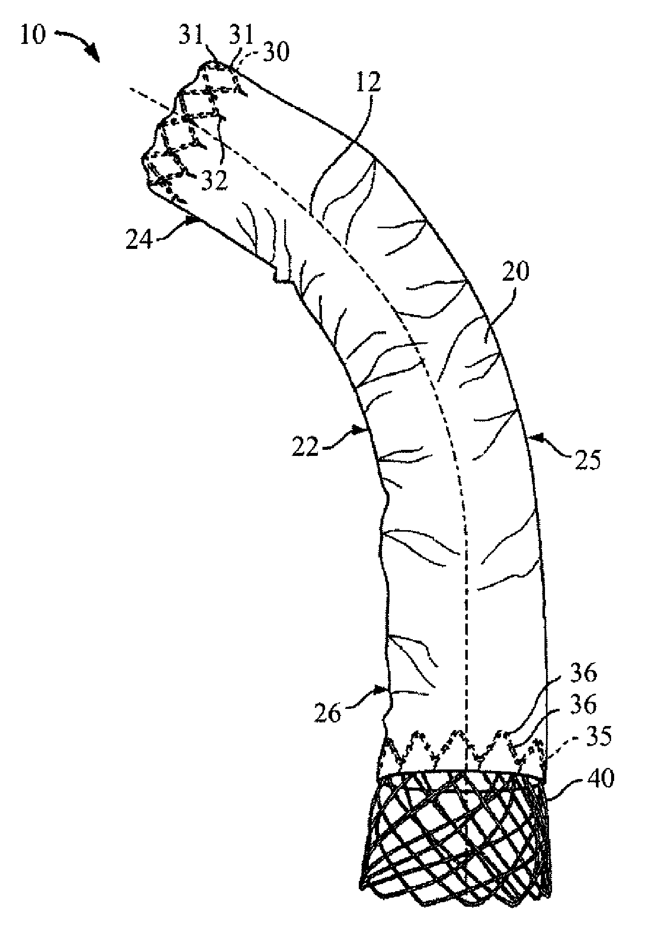 Stent for Endovascular Procedures