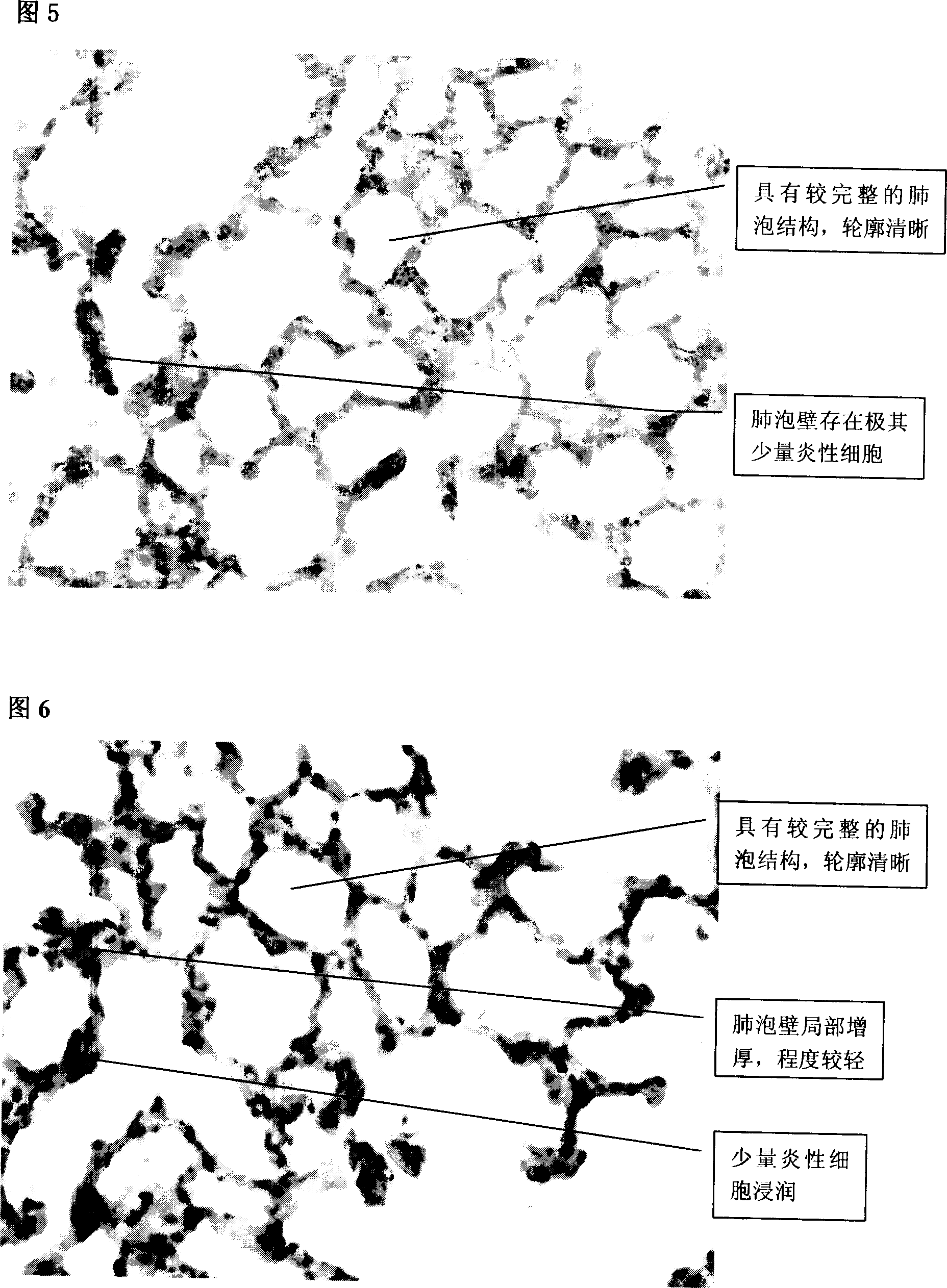 Use of bupleurum root total polyoses in the preparing of medicine for preventing and treating acute respiratory distress syndrome