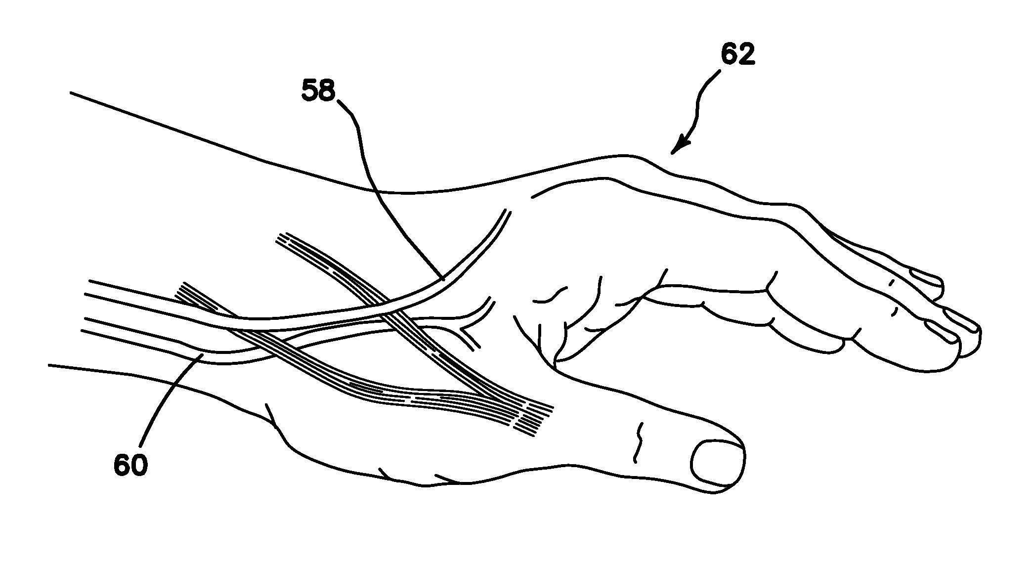 Systems and methods for creating arteriovenous (AV) fistulas