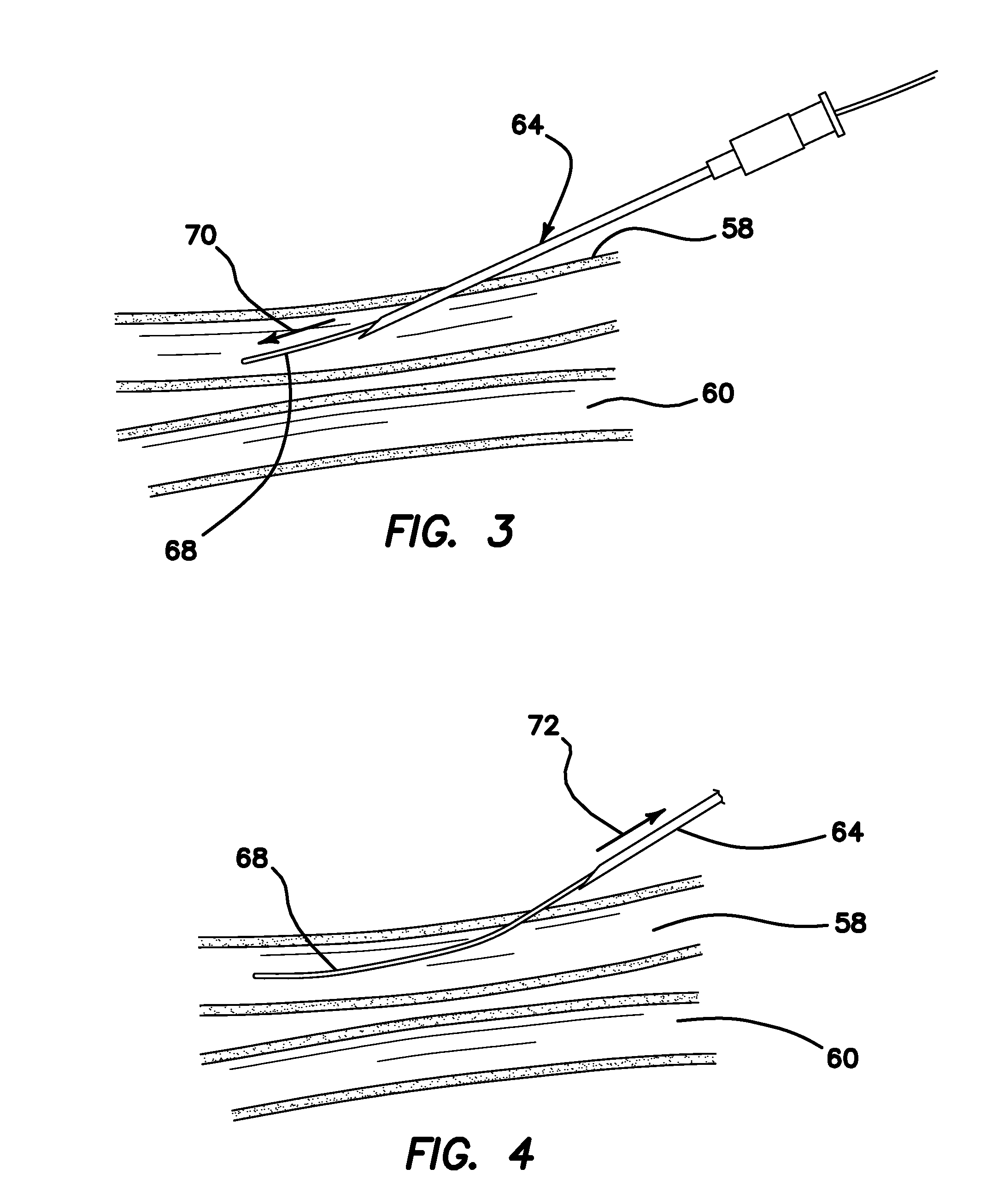 Systems and methods for creating arteriovenous (AV) fistulas