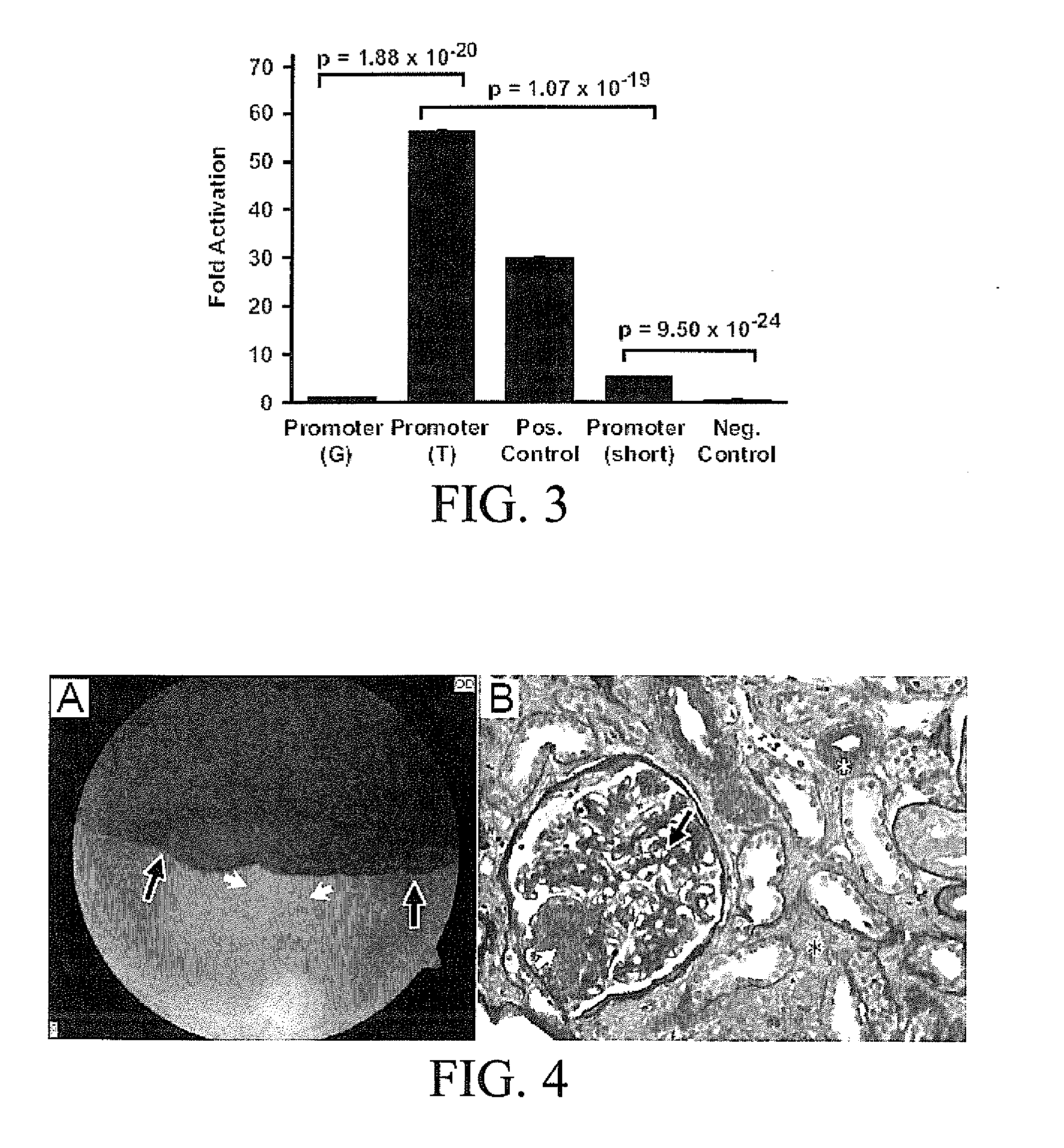 Compositions and Methods For Diagnosing and Treating Diabetic Micro Vascular Complications