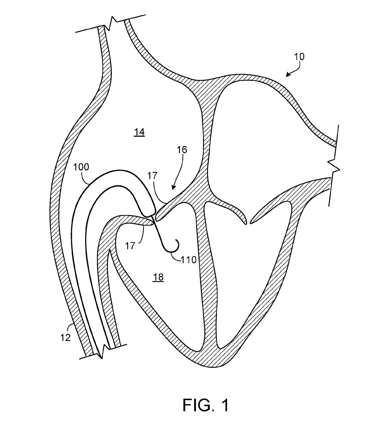 Percutaneously-deployable prosthetic tricuspid valve