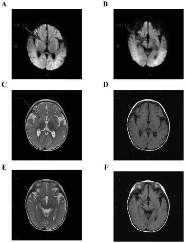 Reagent kit for diagnosing mitochondrial encephalomyopathy and application