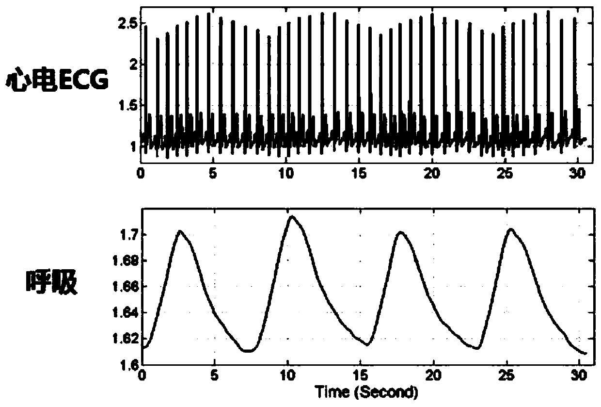 Cardiopulmonary Coupling Analysis Method Based on Single Lead ECG