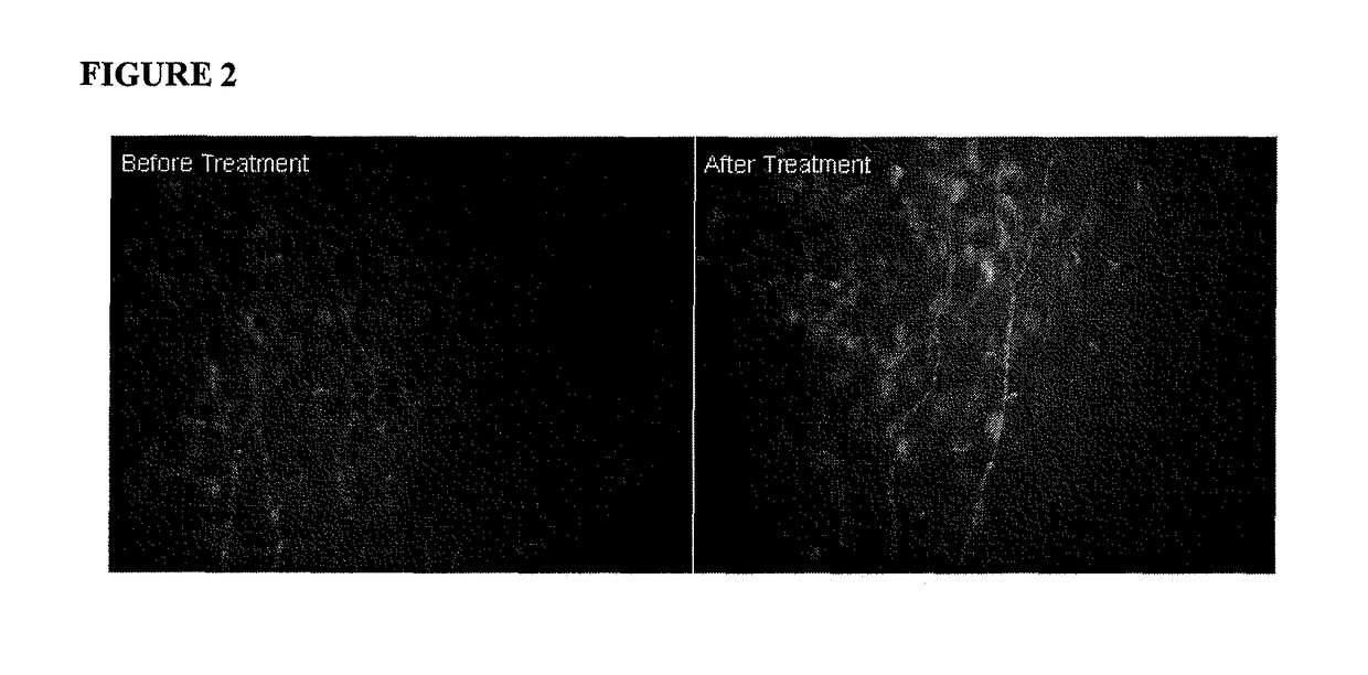 Methods for reducing corneal nerves damage, corneal lymphangiogenesis or immunity to corneal antigens in dry-eye associated ocular surface diseases by IL-1Ra