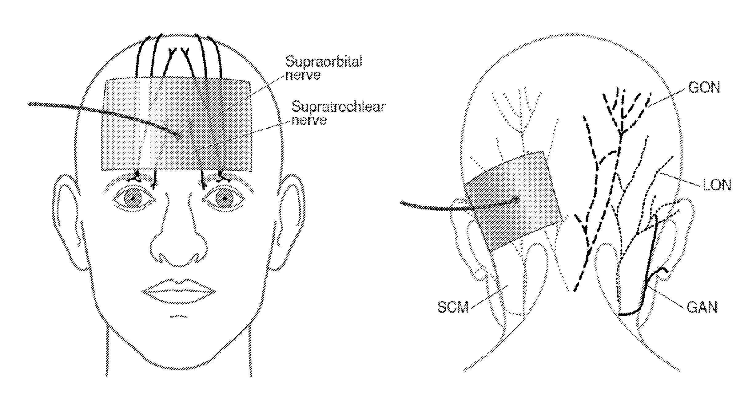 Eliciting analgesia by transcranial electrical stimulation