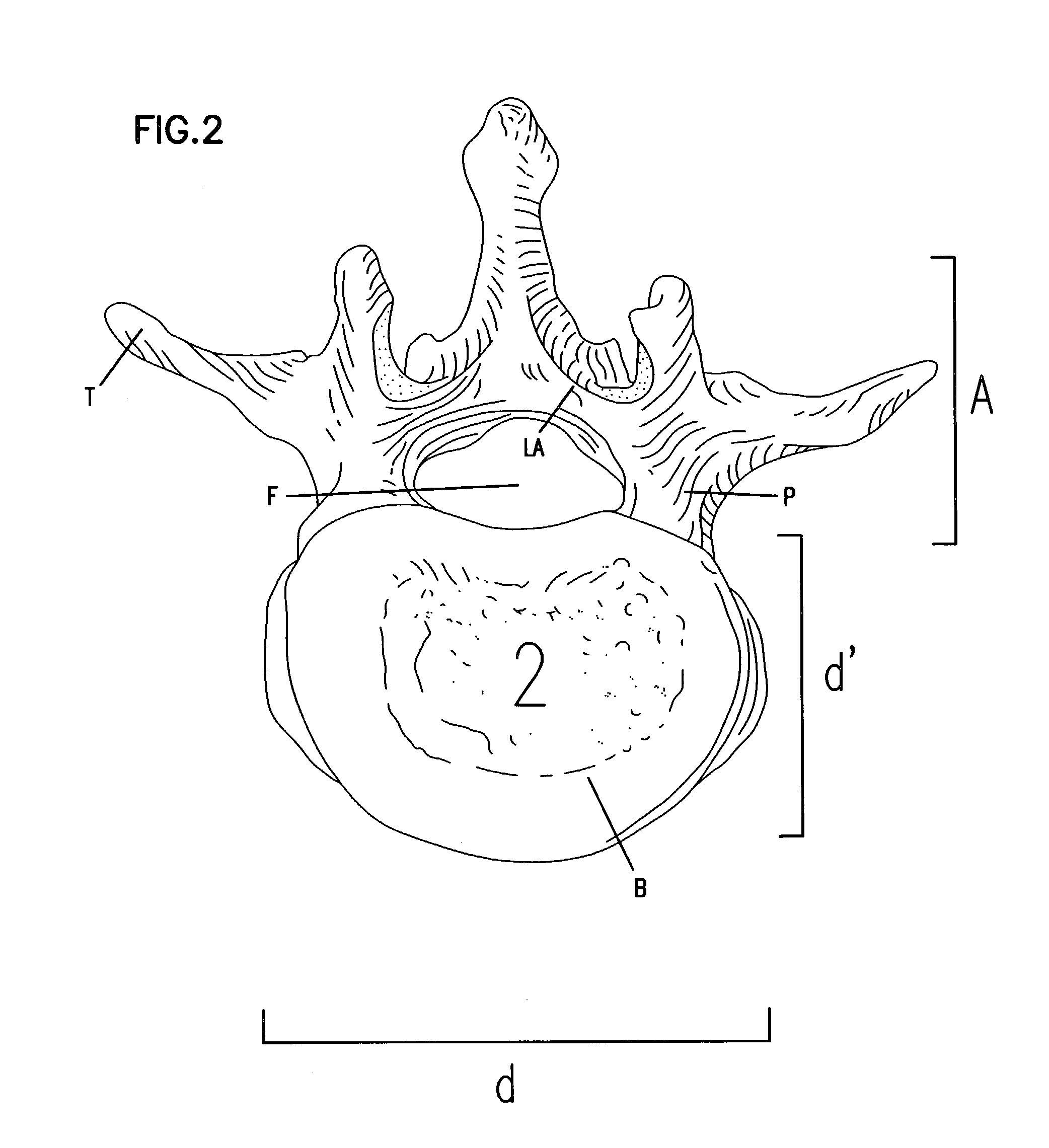 Spinal fixation device and method