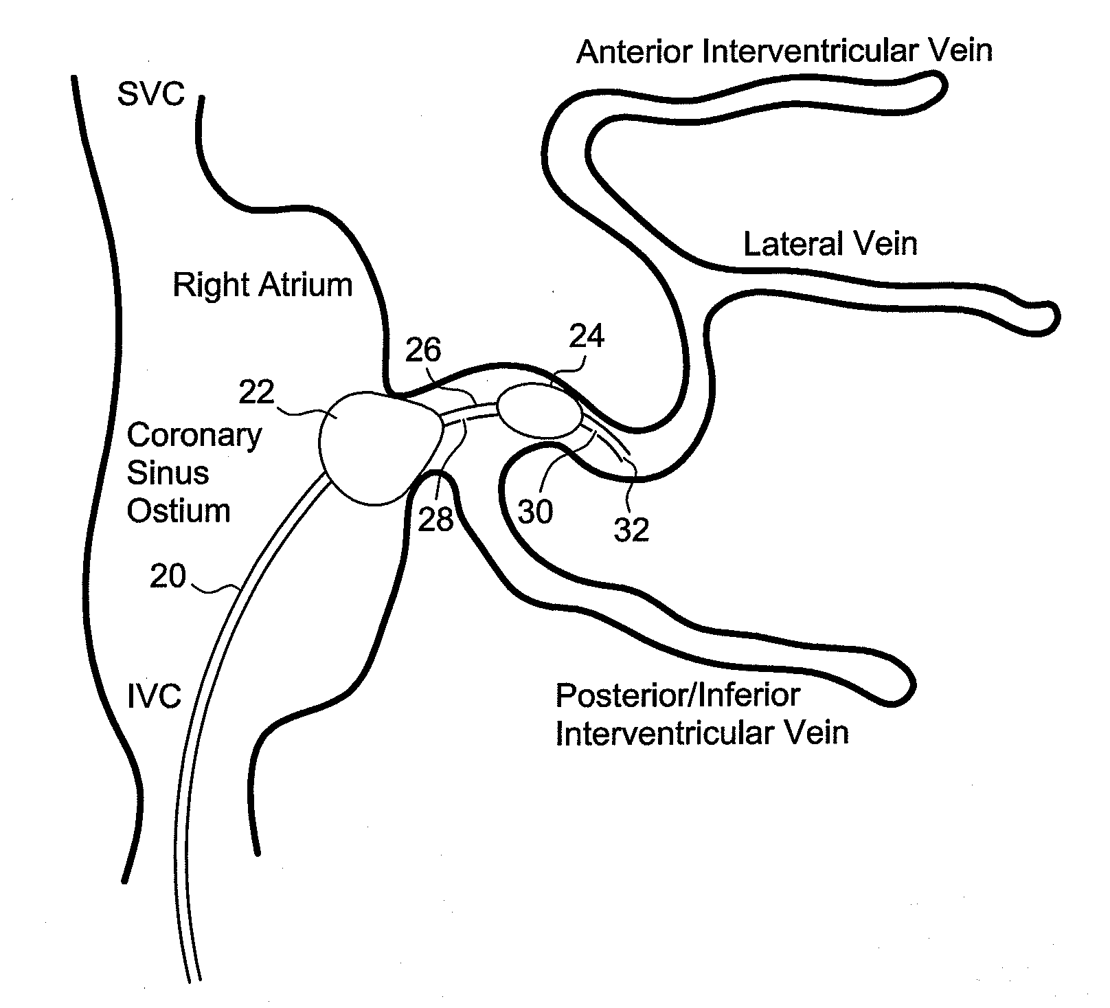 Method and system for preventing contrast associated nephropathy