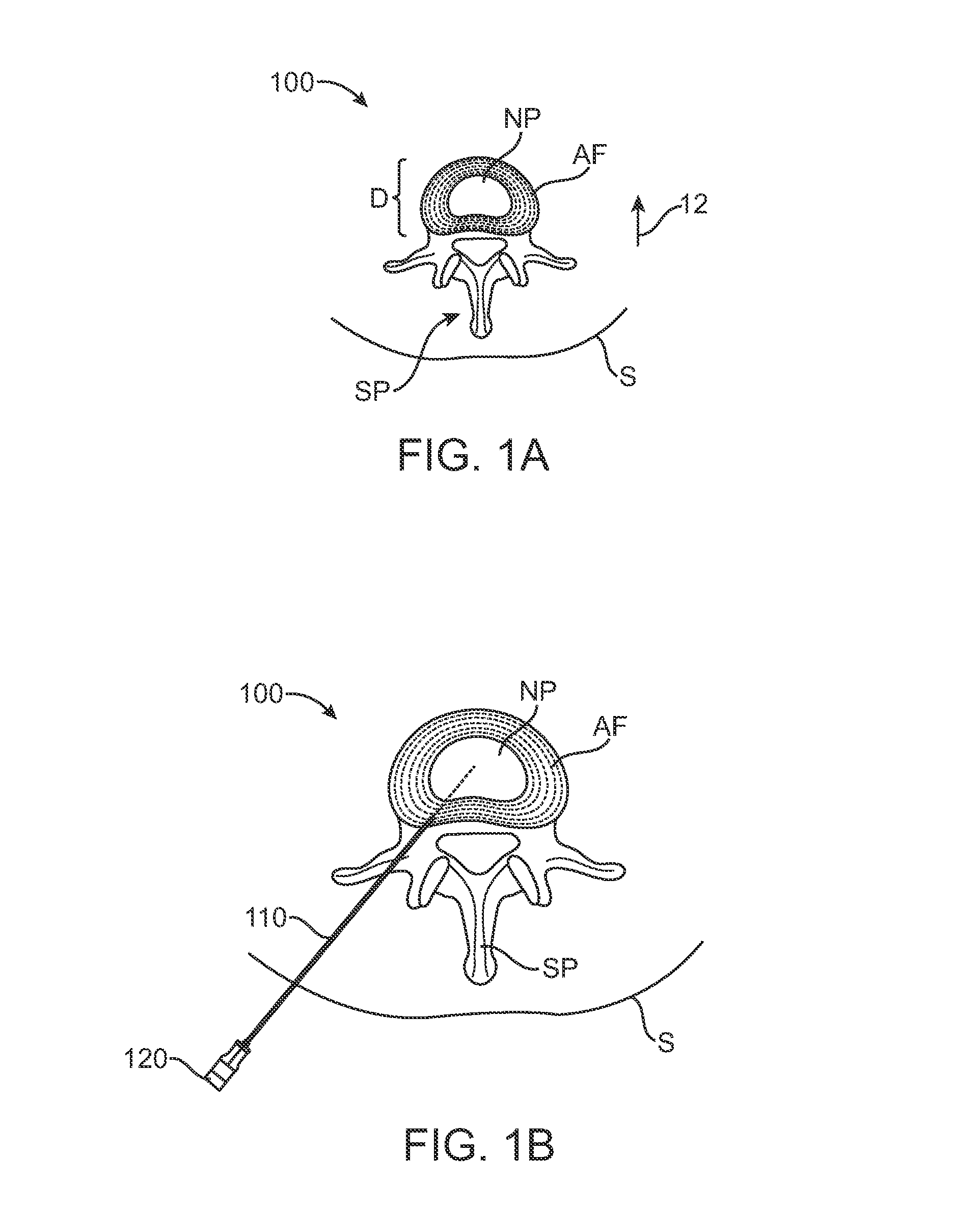 Systems and Methods for Needle Access to an Intervertebral Disc