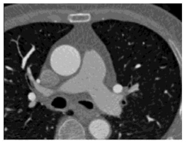 Coronary artery stenosis estimation method, system and device