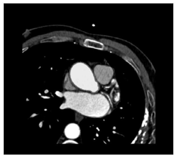 Coronary artery stenosis estimation method, system and device