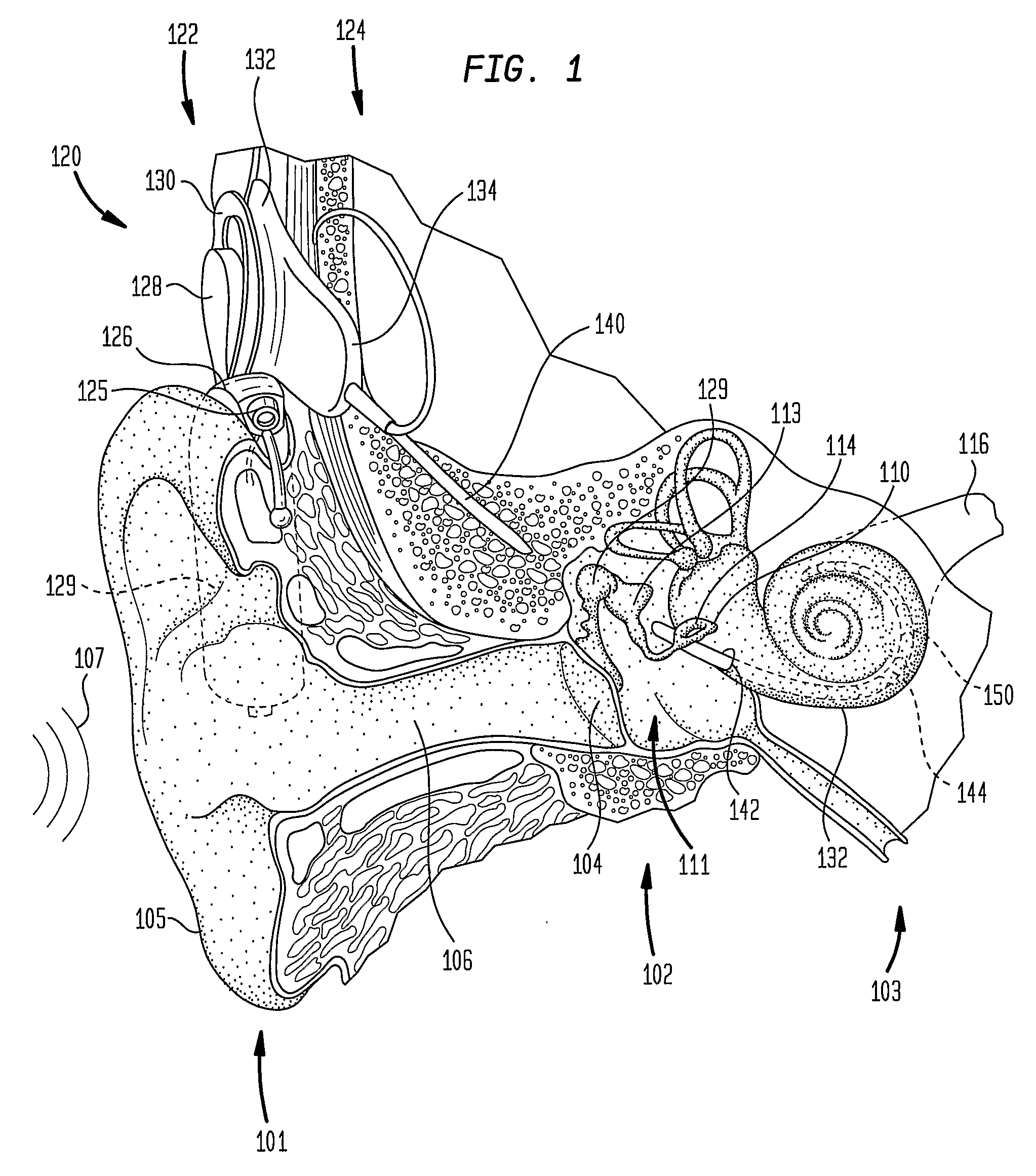 Elongate implantable carrier member having an embedded stiffener