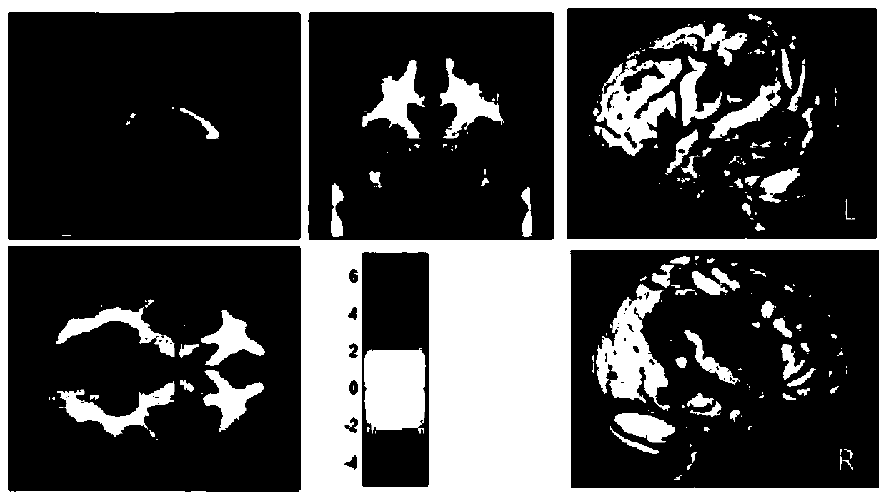 An Alzheimer's disease MRI image classification method based on an SVM-RFE-MRMR algorithm