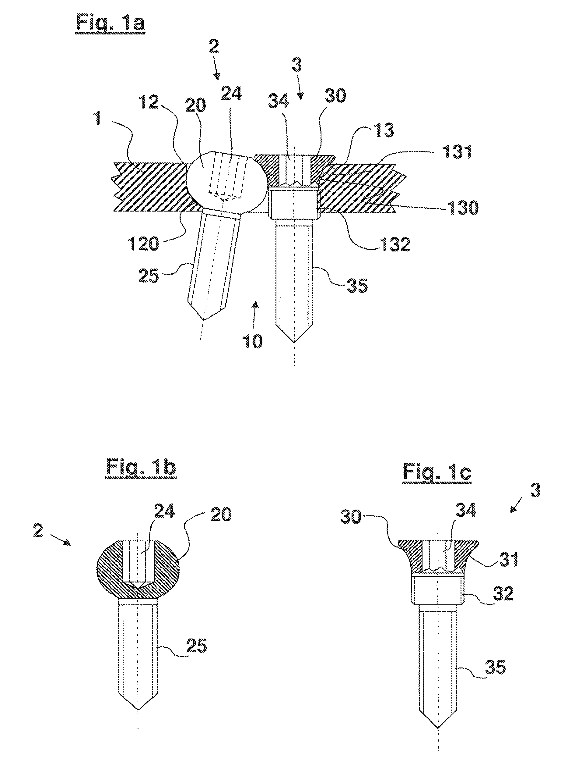 Bone plate system for osteosynthesis