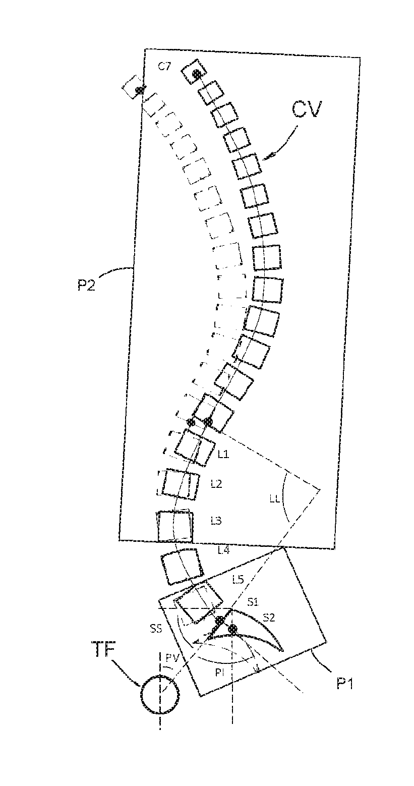 Method making it possible to produce the ideal curvature of a rod of vertebral osteosynthesis material designed to support a patient vertebral column