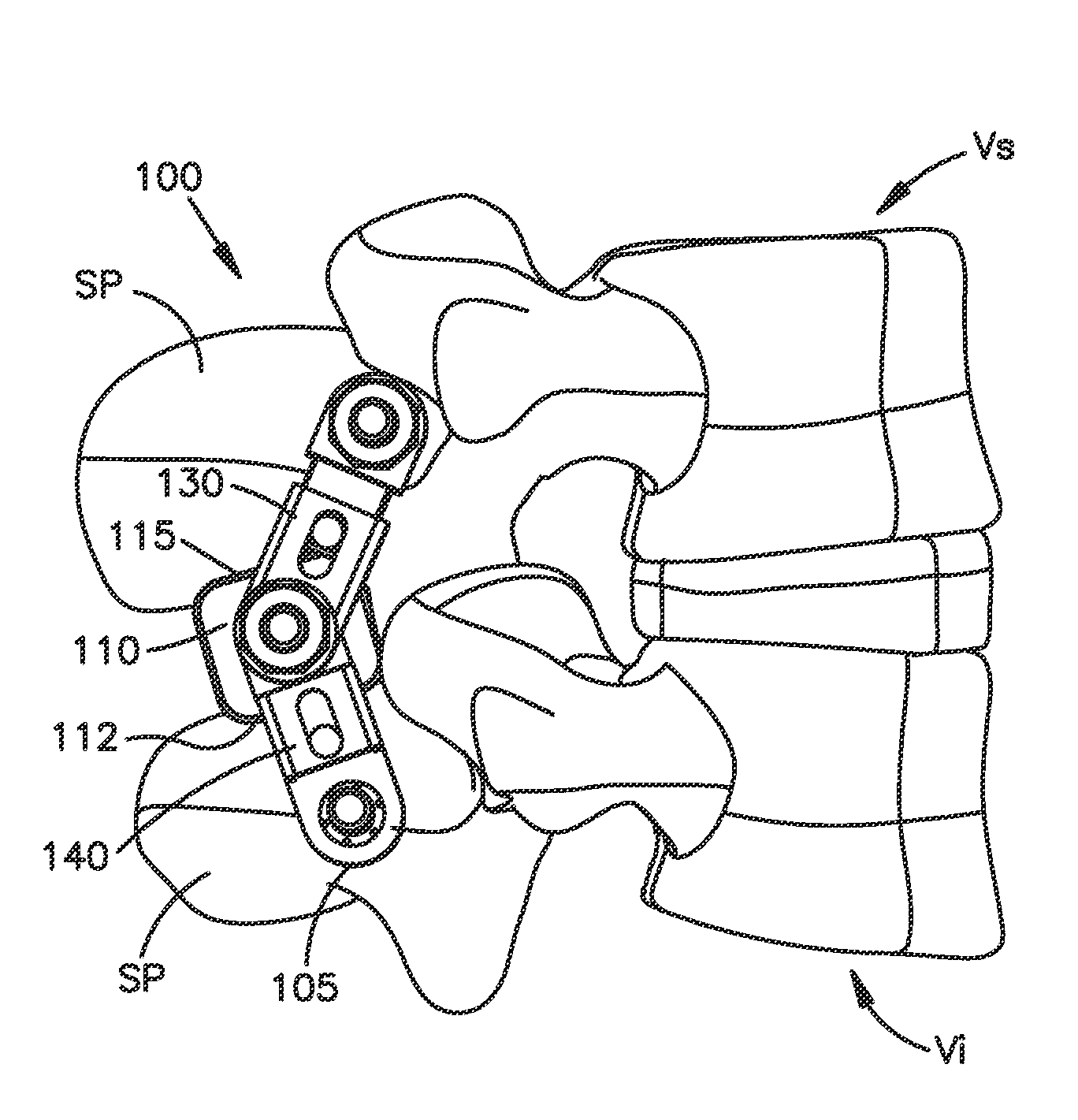 Interspinous spacer assembly