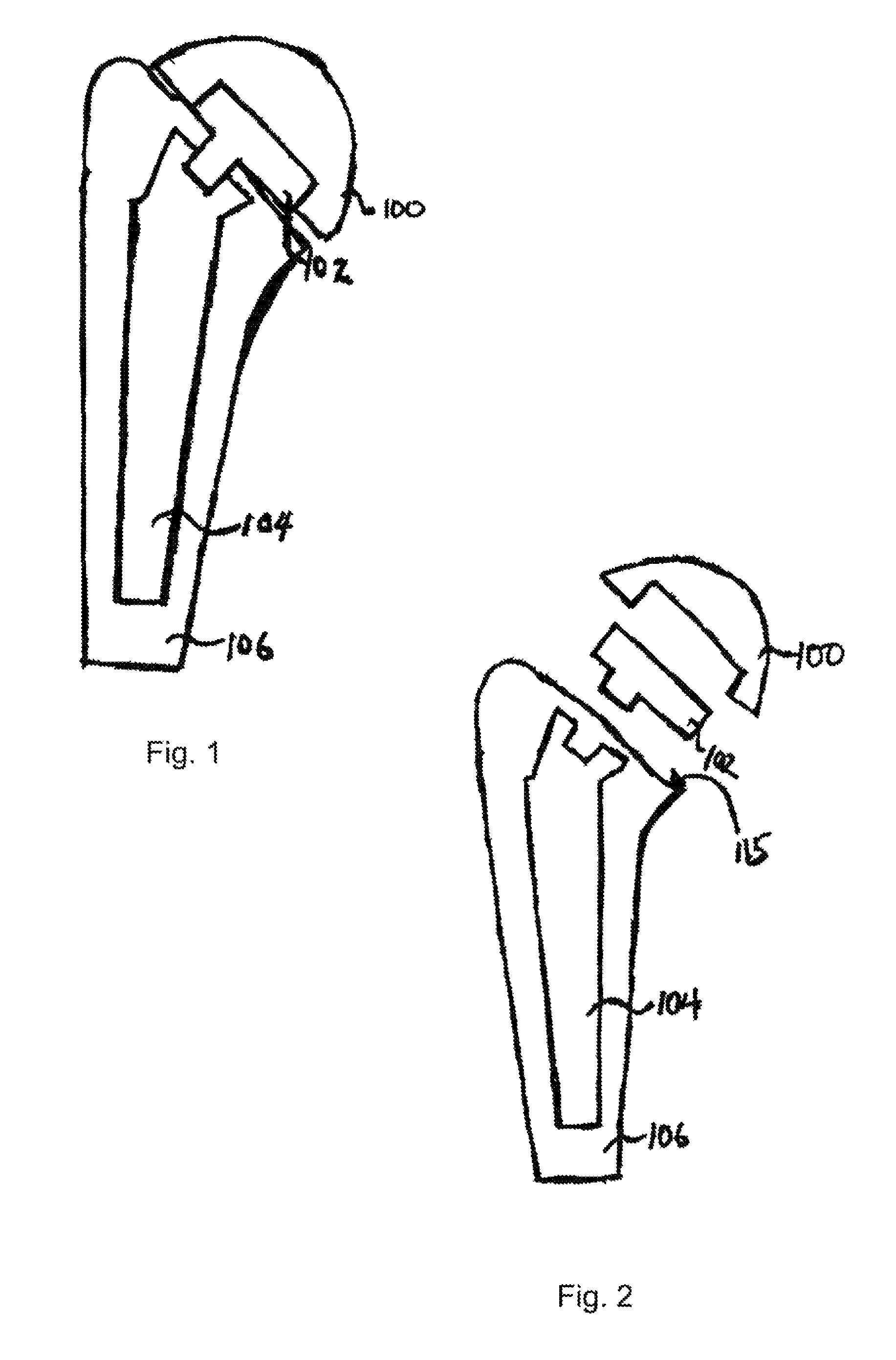 Humeral joint replacement component