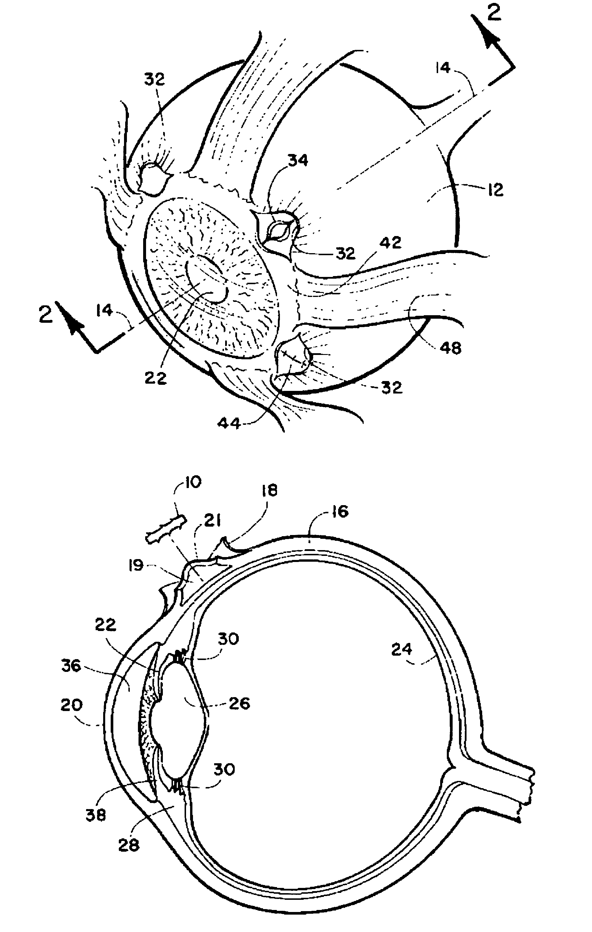 Method and intra sclera implant for treatment of glaucoma and presbyopia