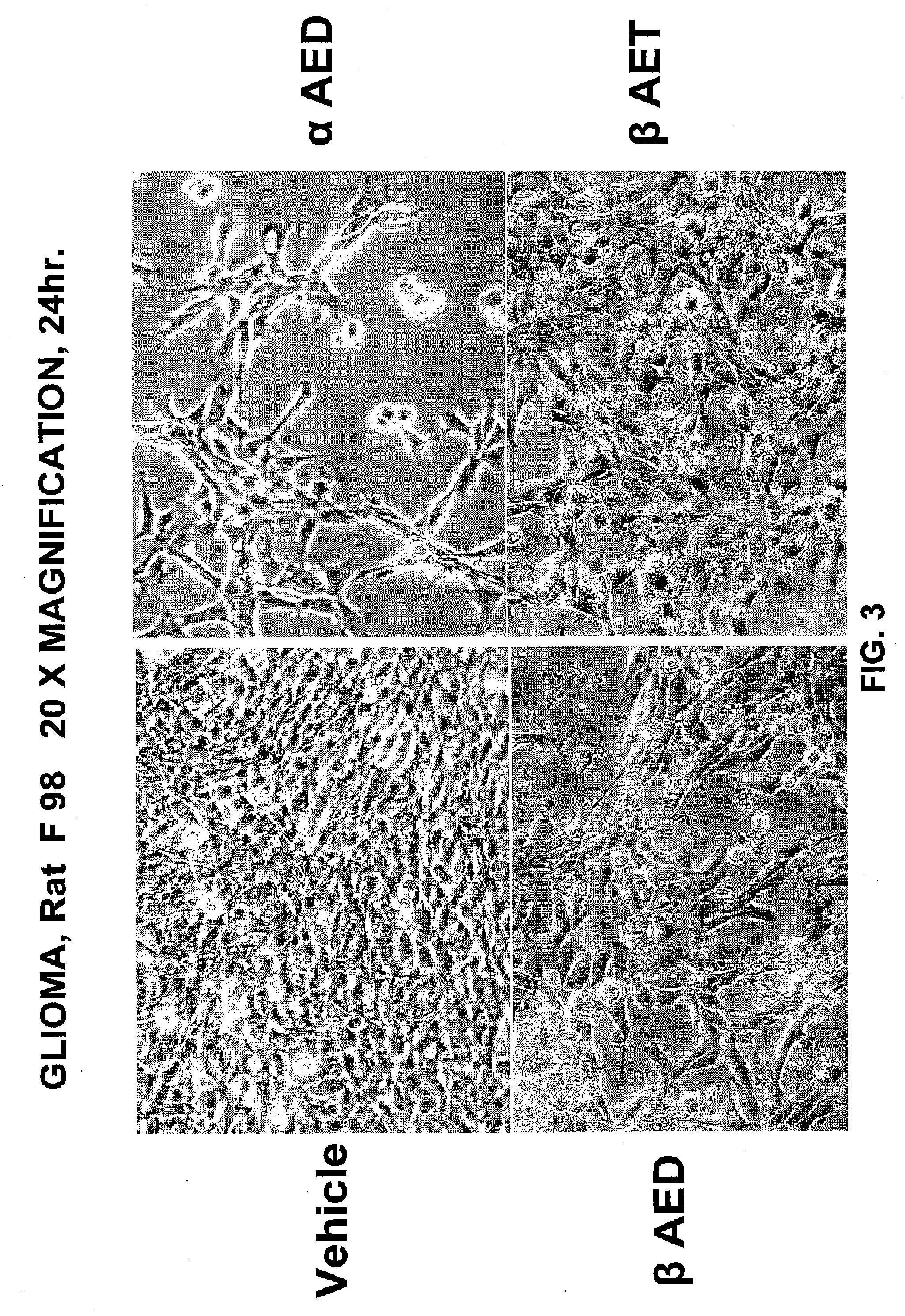 5-Androstenediol As An Inhibitor of Gliomas