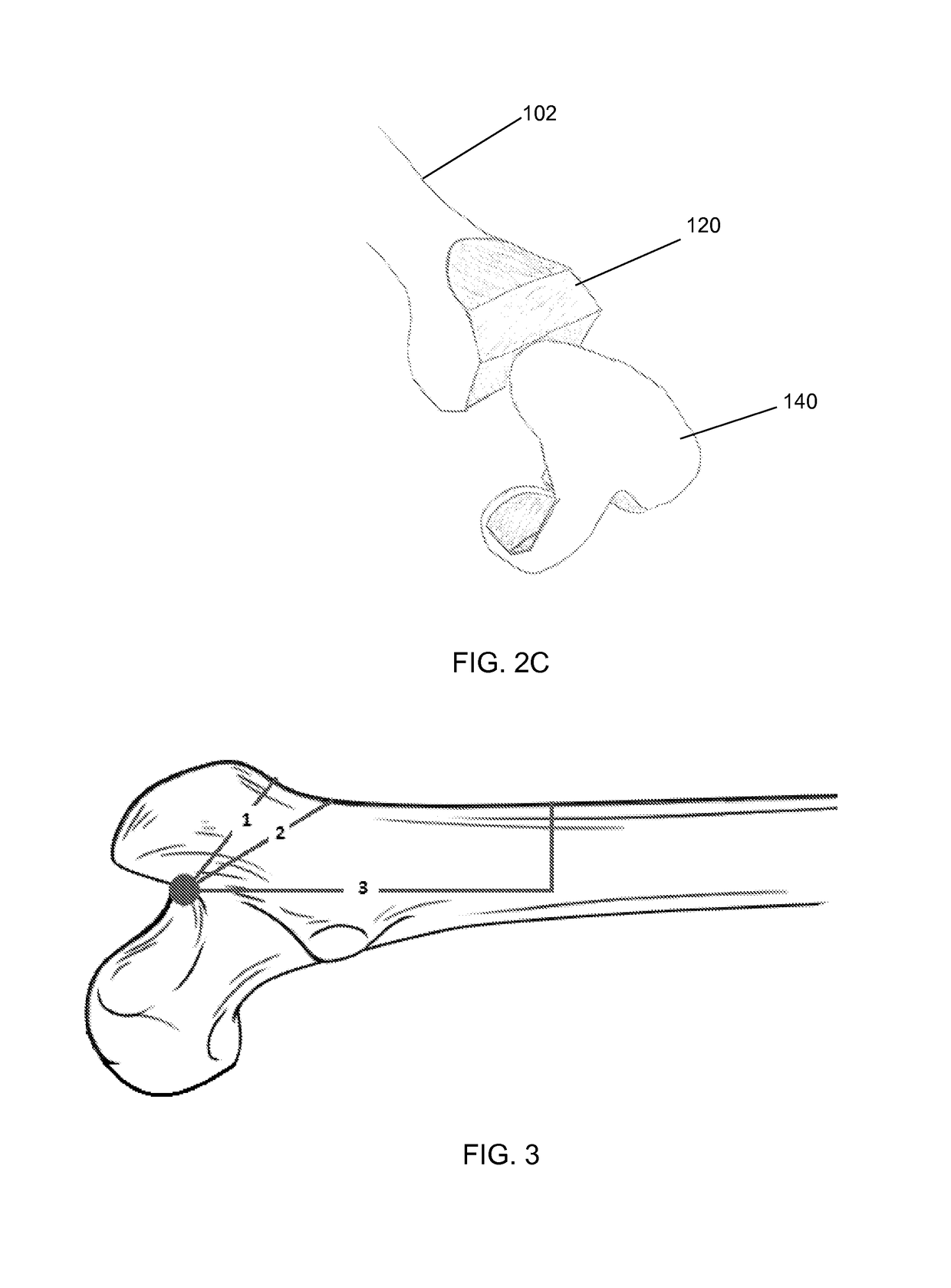 Implant based planning, digitizing, and registration for total joint arthroplasty