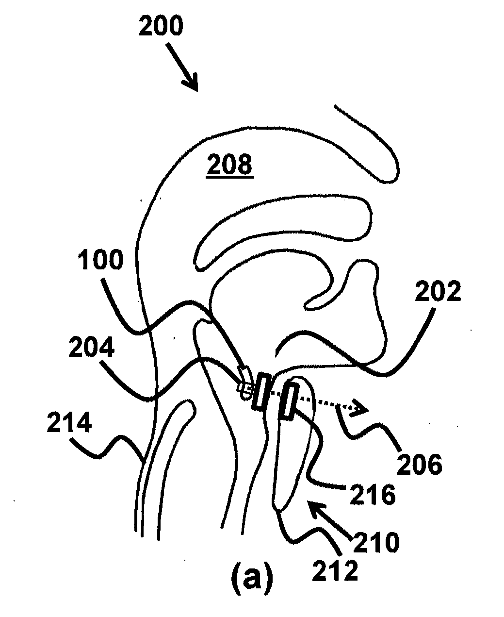 Device and method for correcting obstructive sleep apnea