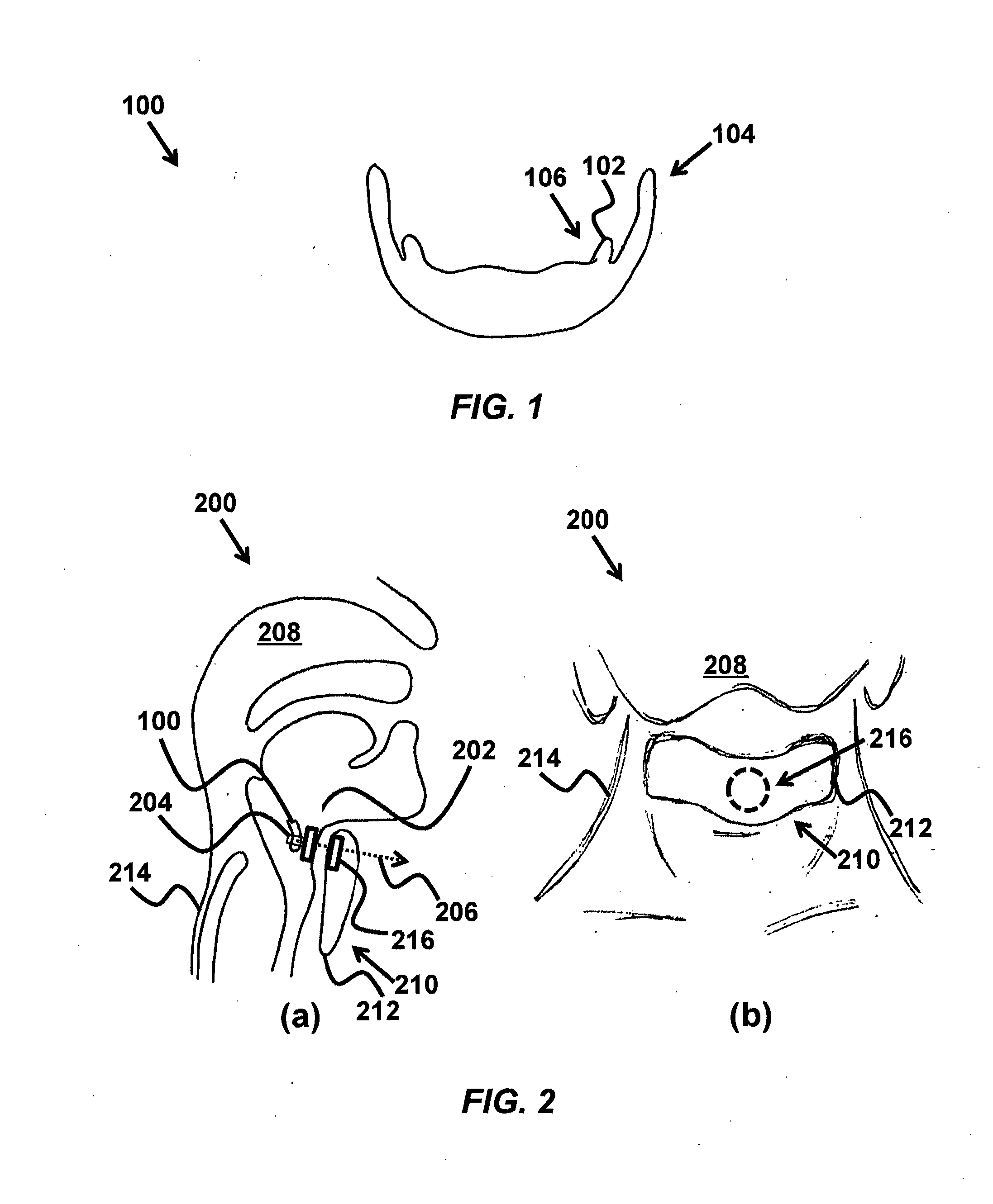 Device and method for correcting obstructive sleep apnea