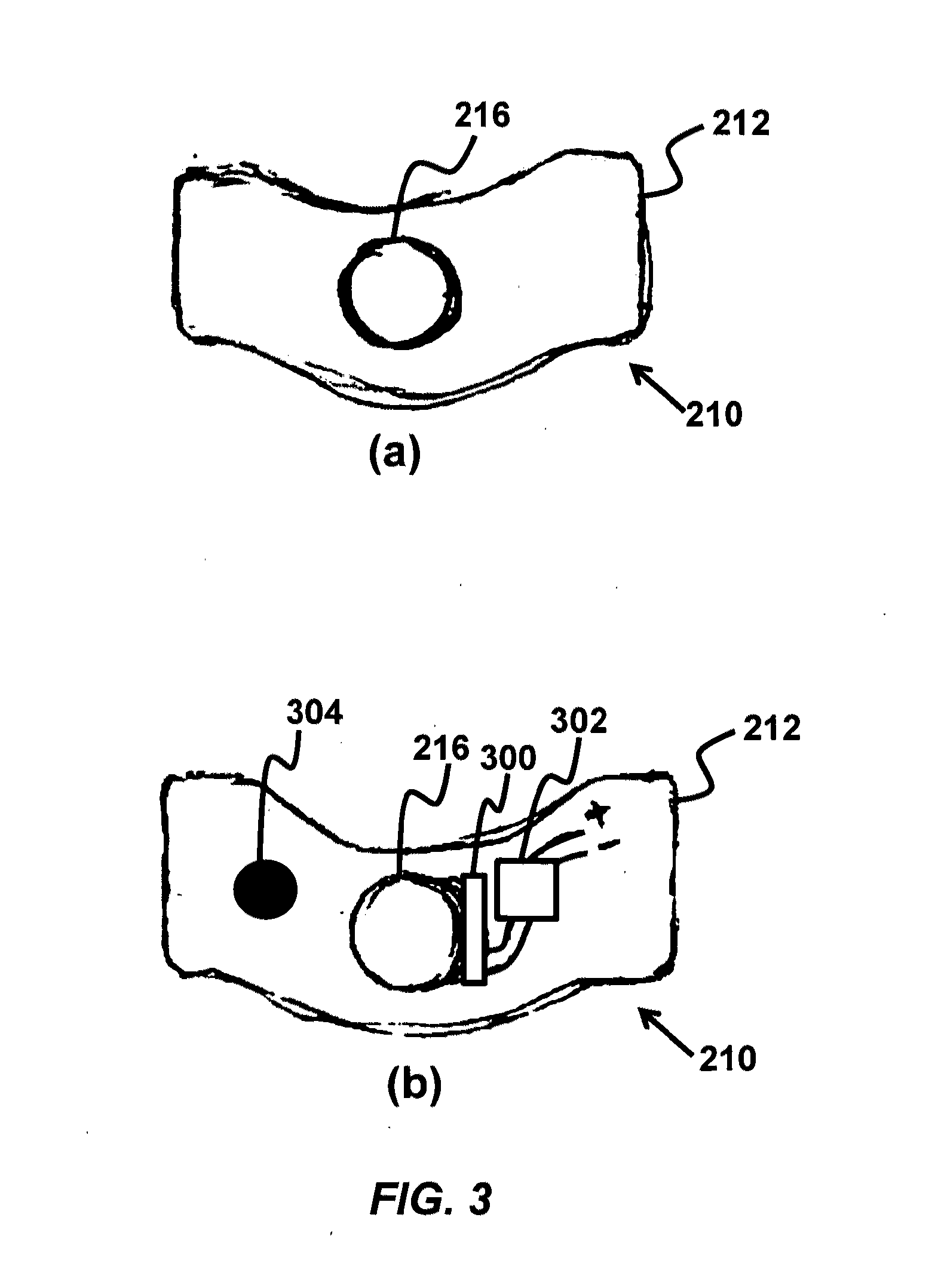 Device and method for correcting obstructive sleep apnea