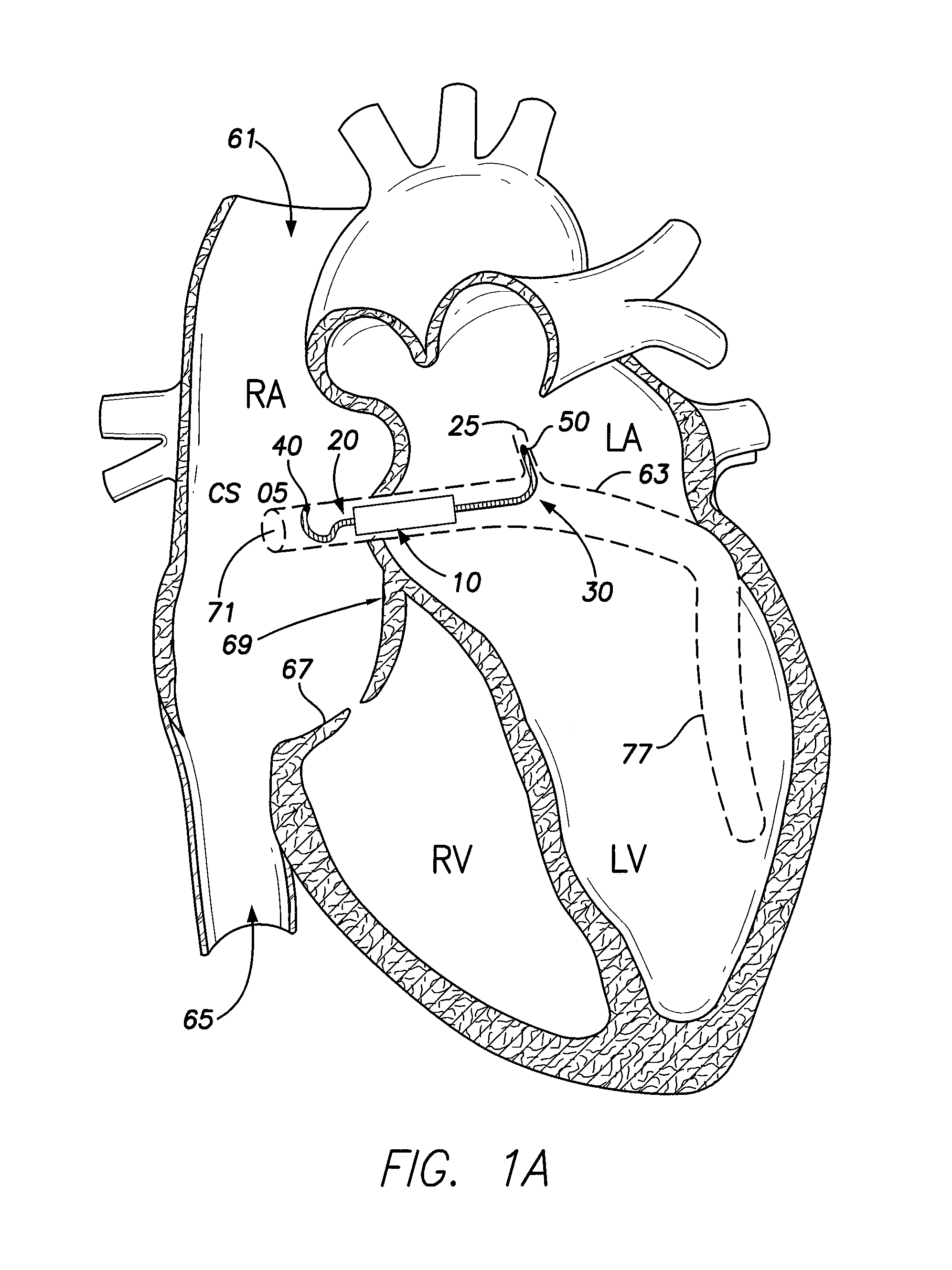 Intracardiac implantable medical device for biatrial and/or left heart pacing and method of implanting same