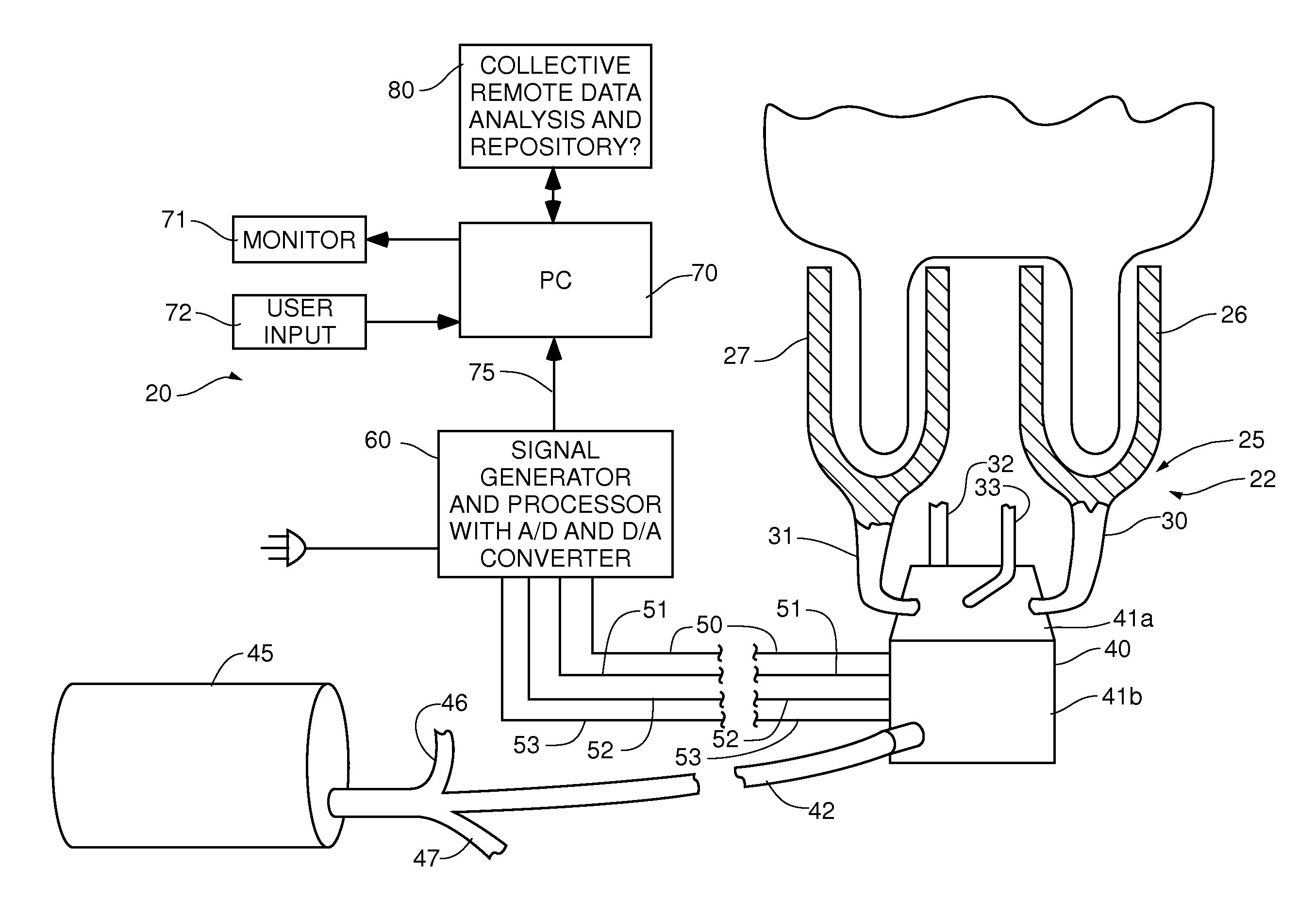 System and method of sub clinical detecting mastitis