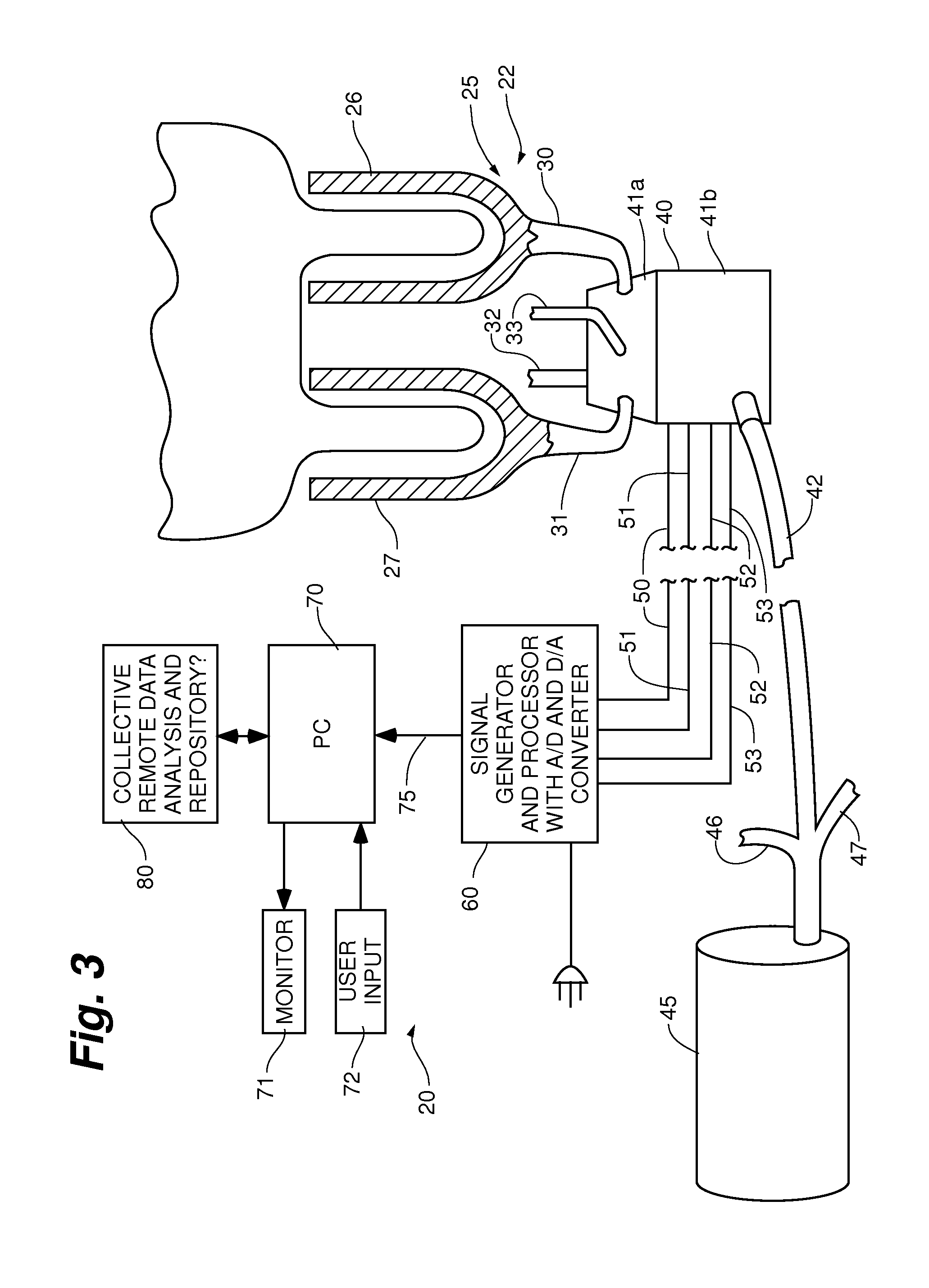 System and method of sub clinical detecting mastitis