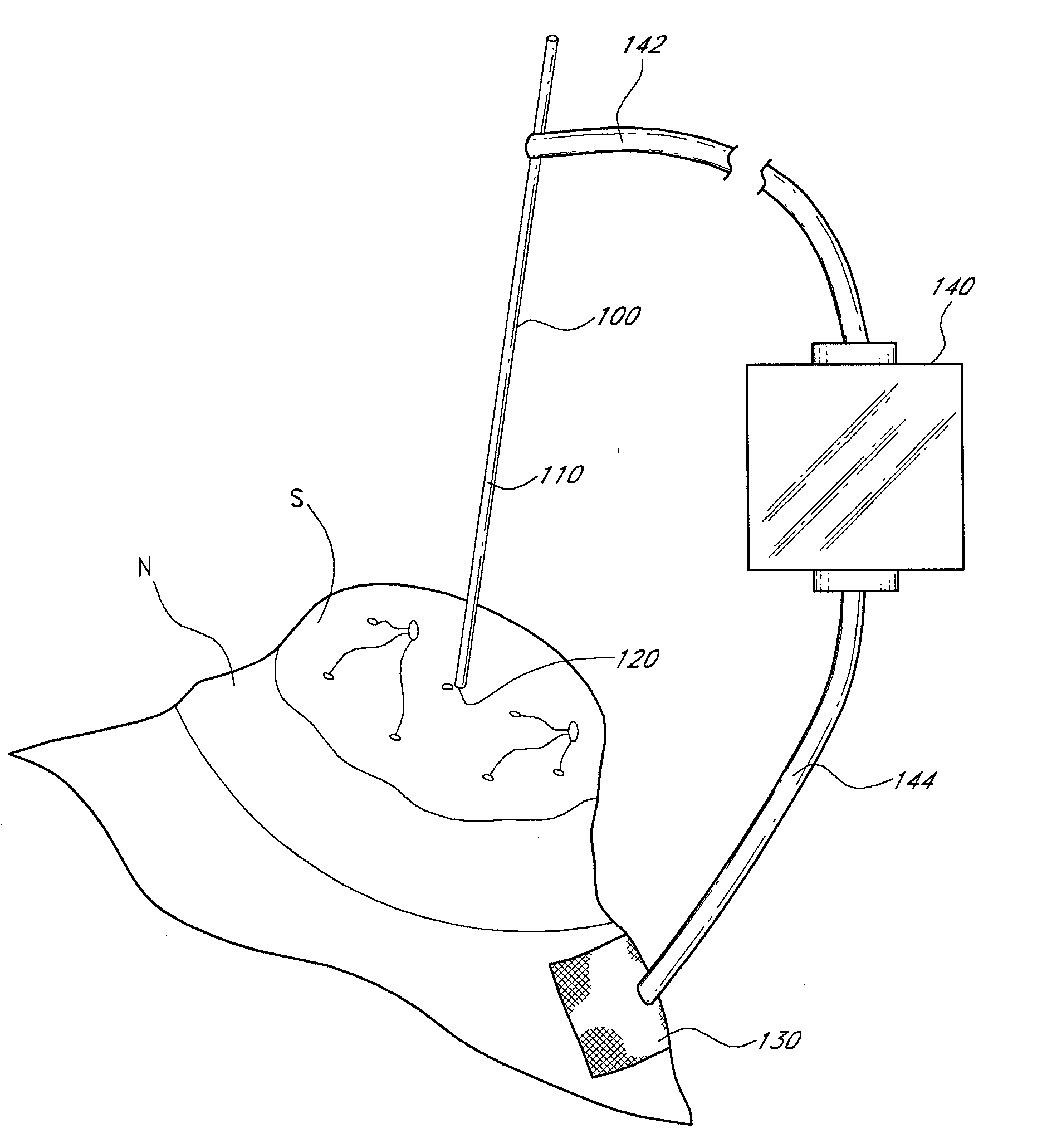 Device and method for accessing and treating ducts of mammary glands