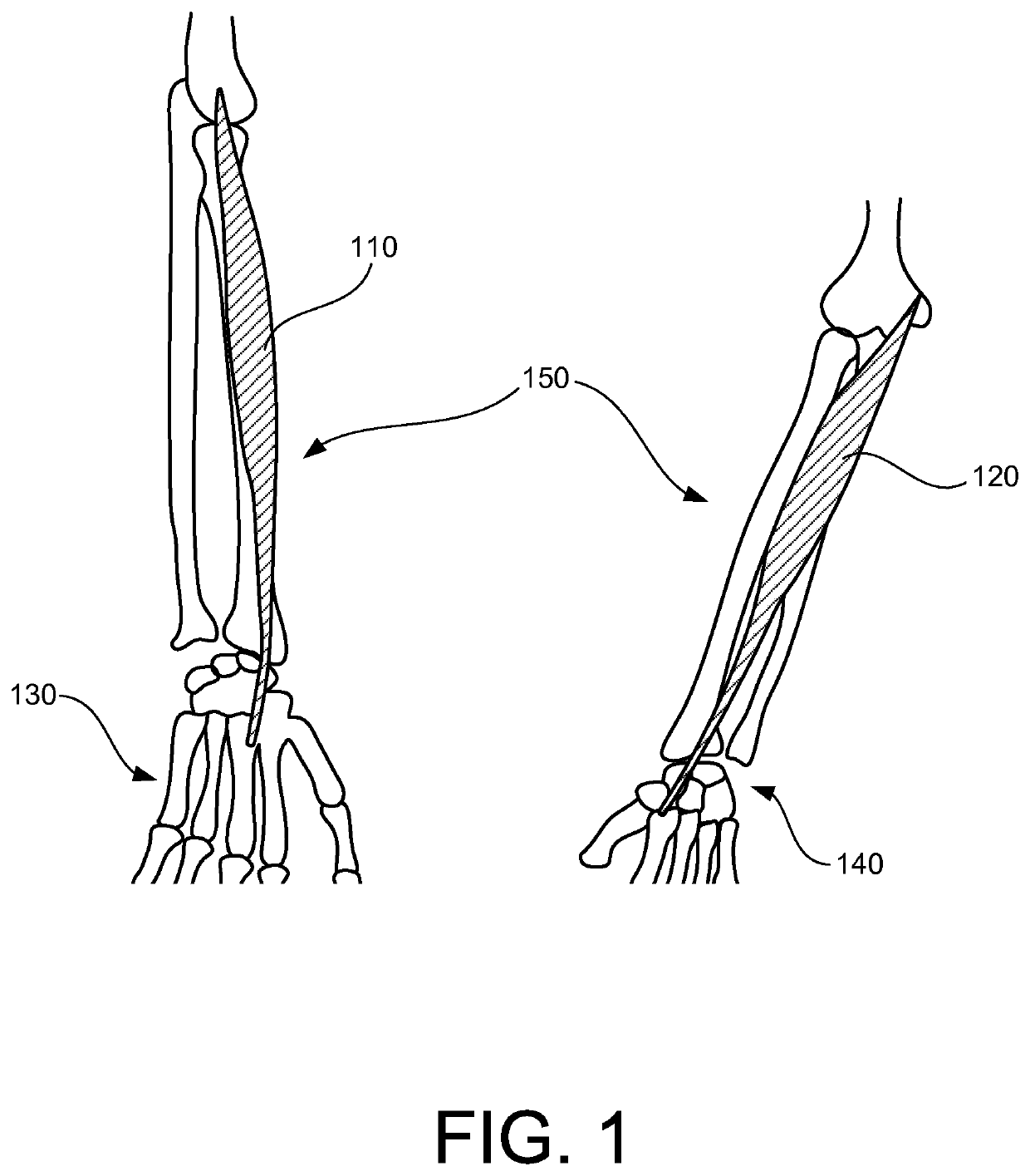 Hand tremor reduction device