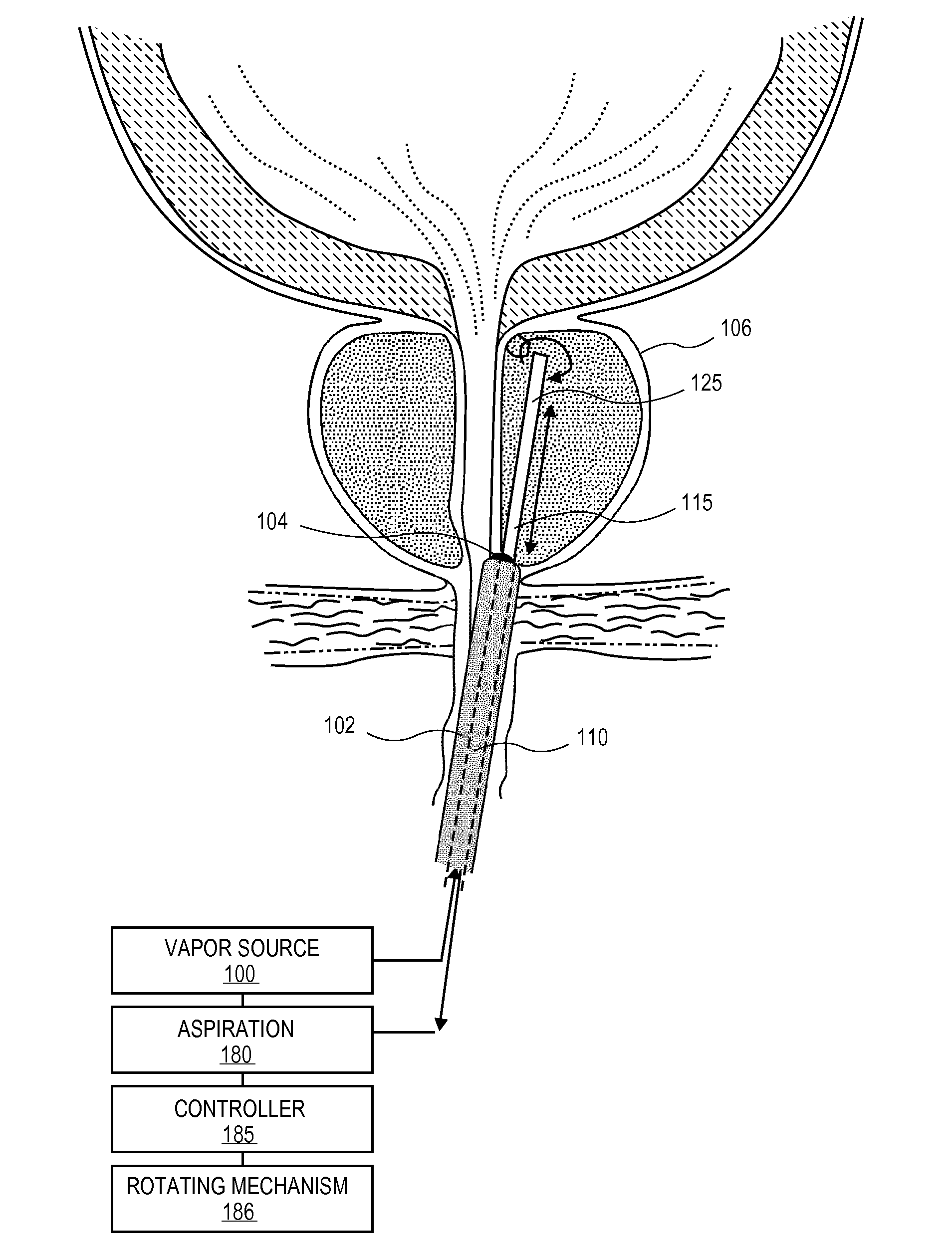 Systems and methods for treatment of prostatic tissue