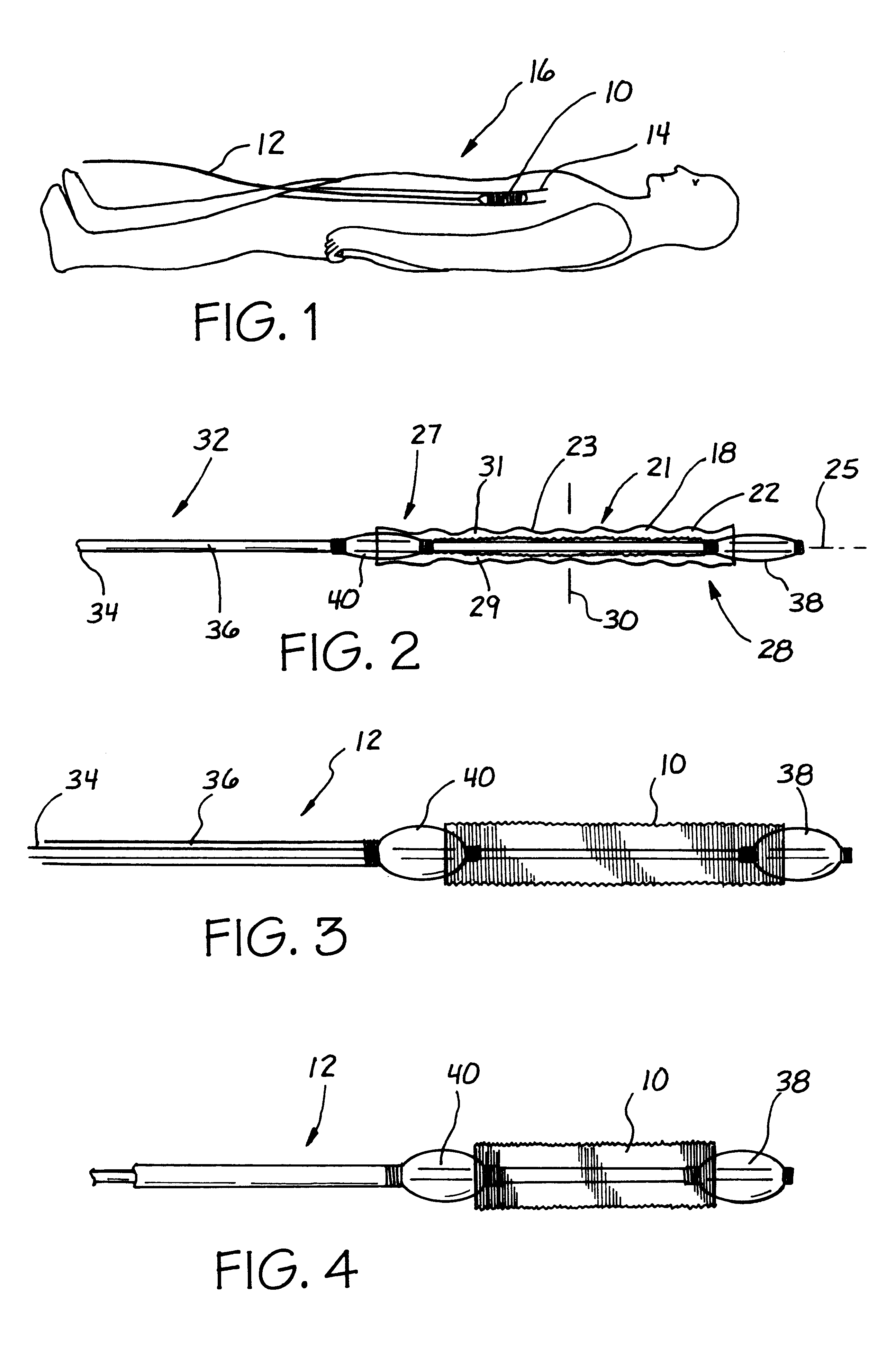 Mesh stent with variable hoop strength