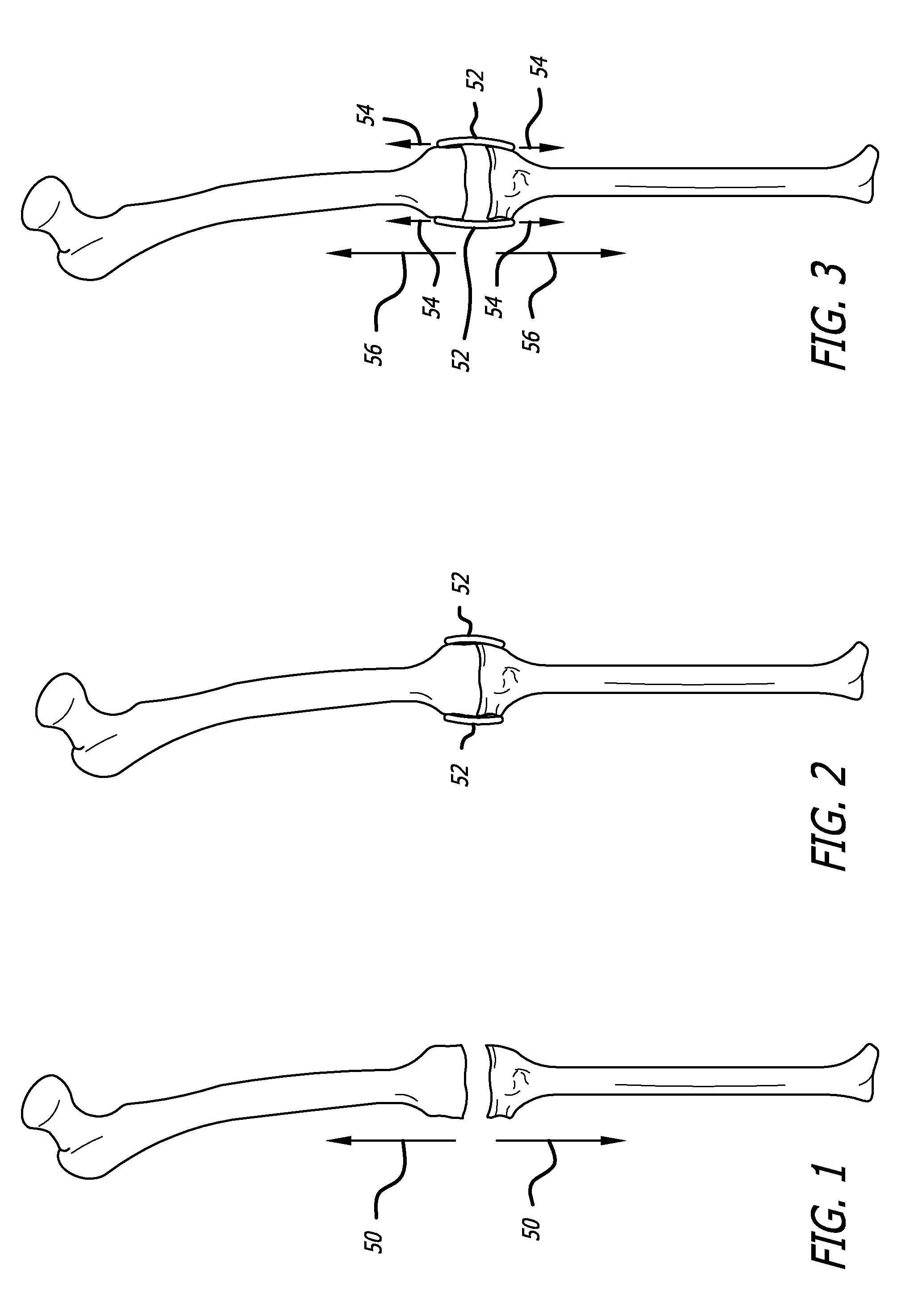 Extra-articular implantable mechanical energy absorbing systems and implantation method