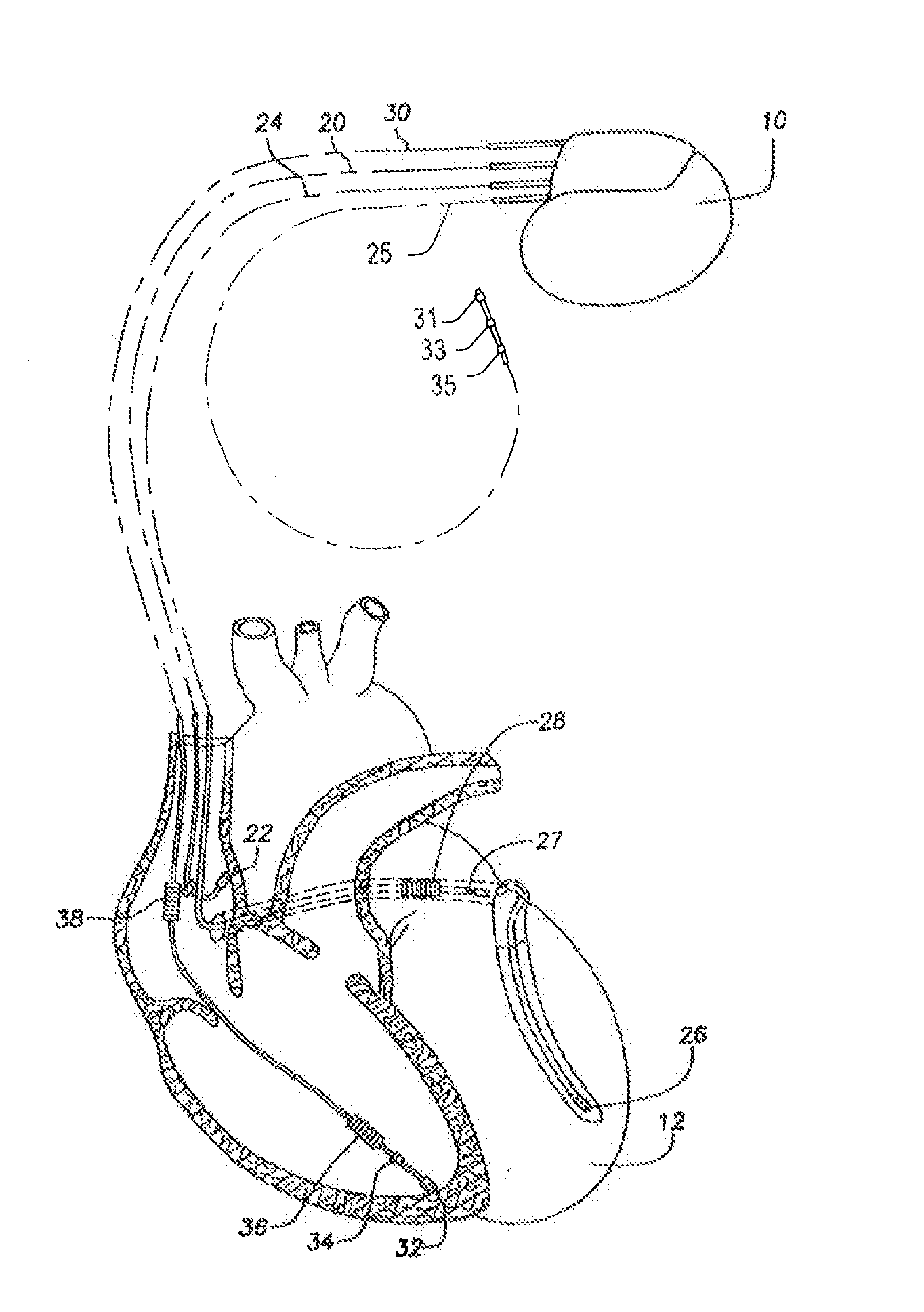 Systems and methods for detecting ischemic events