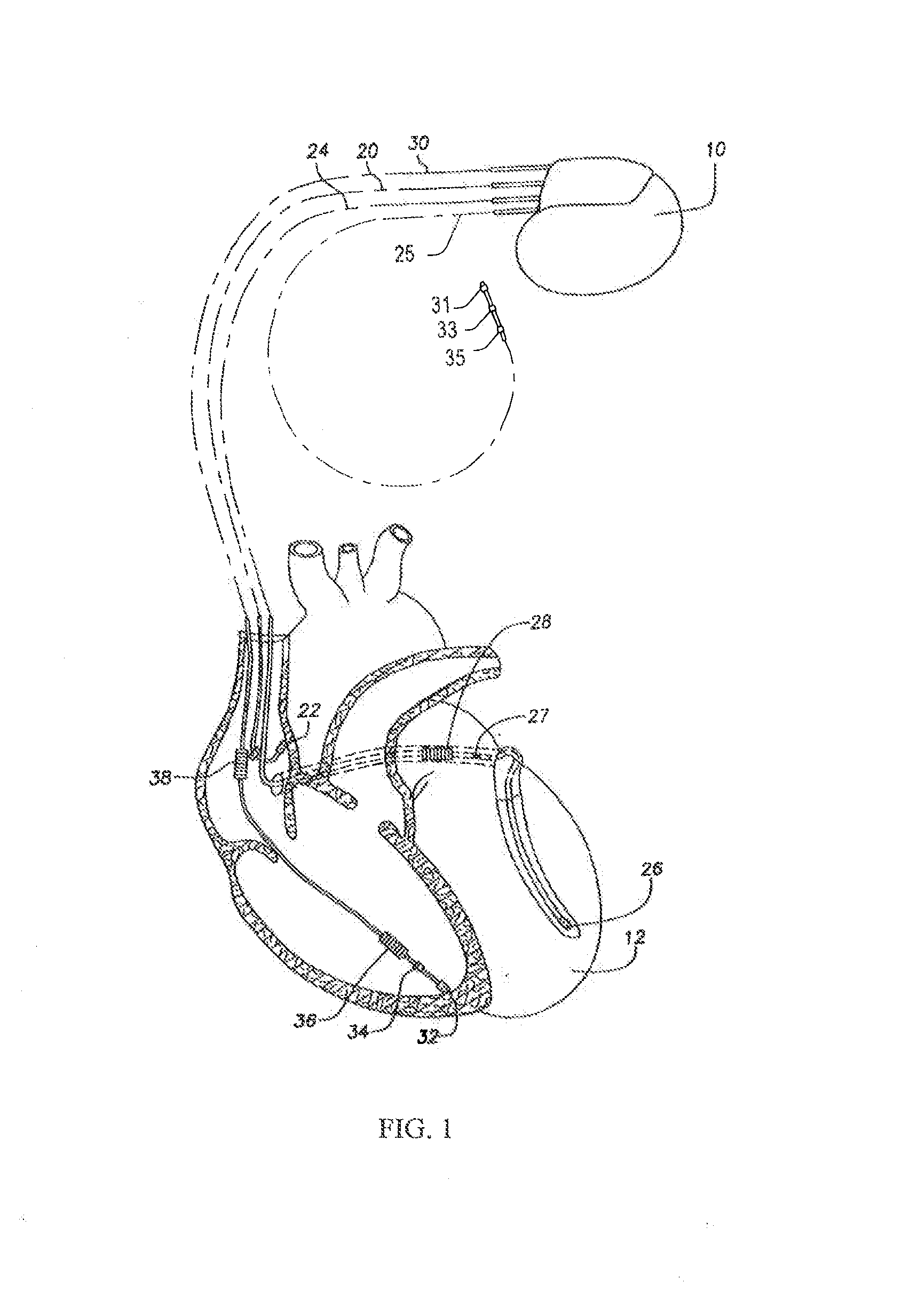 Systems and methods for detecting ischemic events