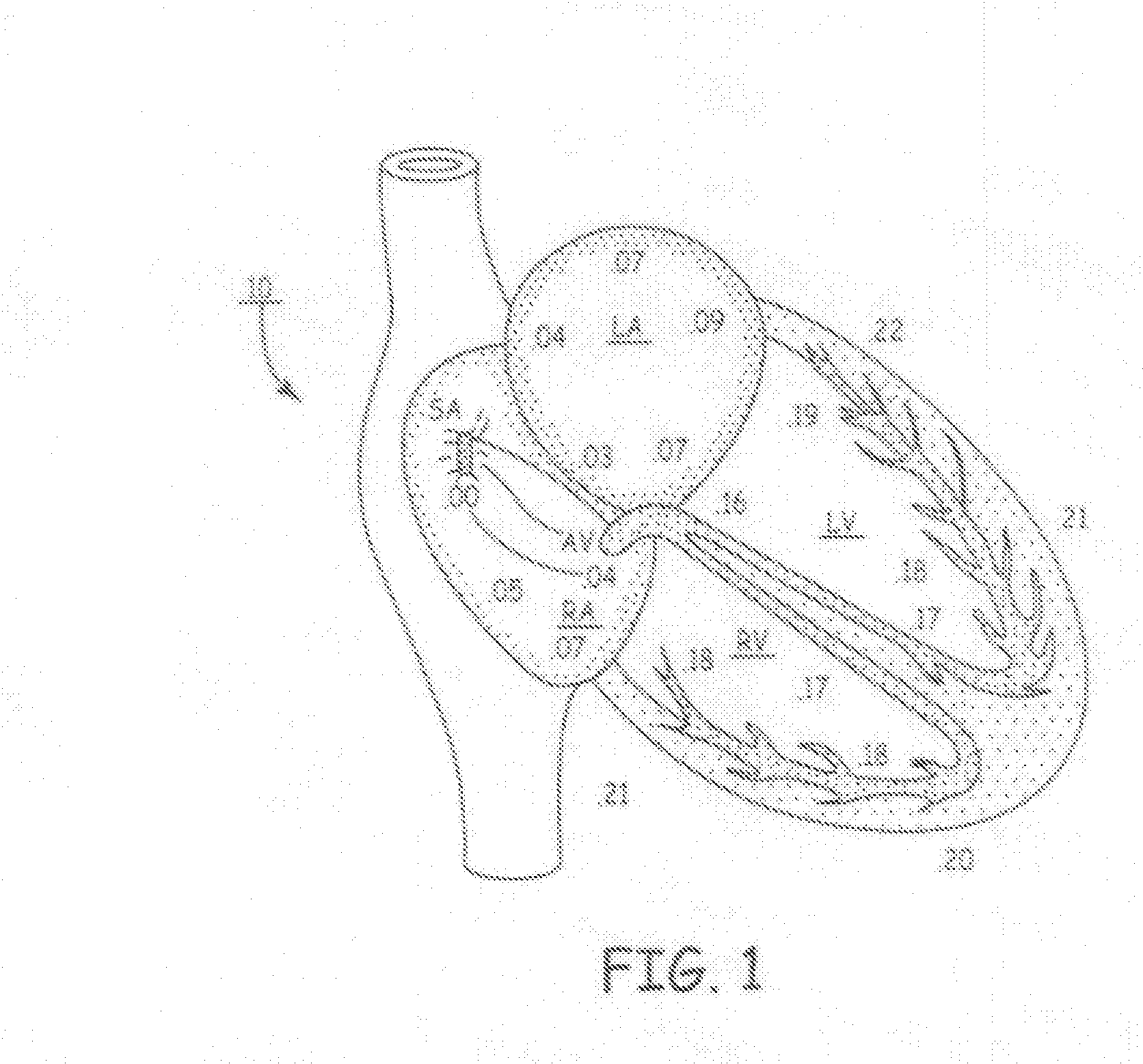 Apparatus and methods for automatic adjustment of av interval to ensure delivery of cardiac resynchronization therapy