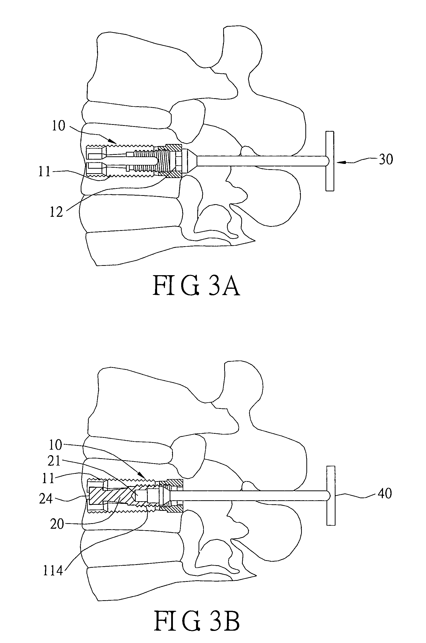 Human bone substitutional implant