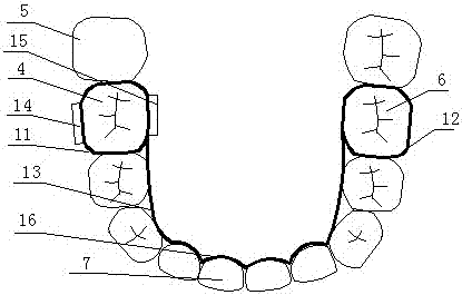 Forward molar erector for bilateral force system