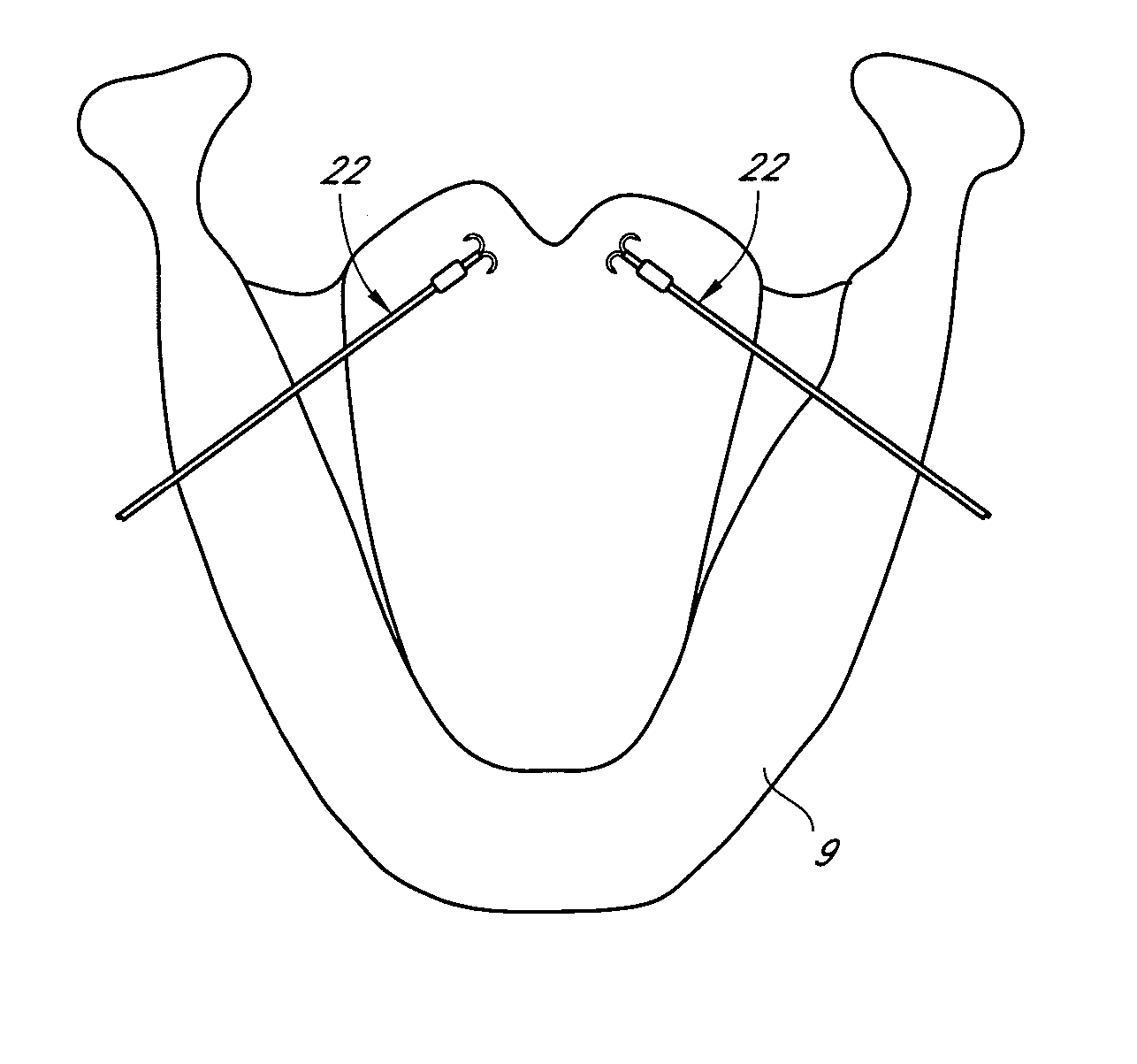 Glossal engagement system and method