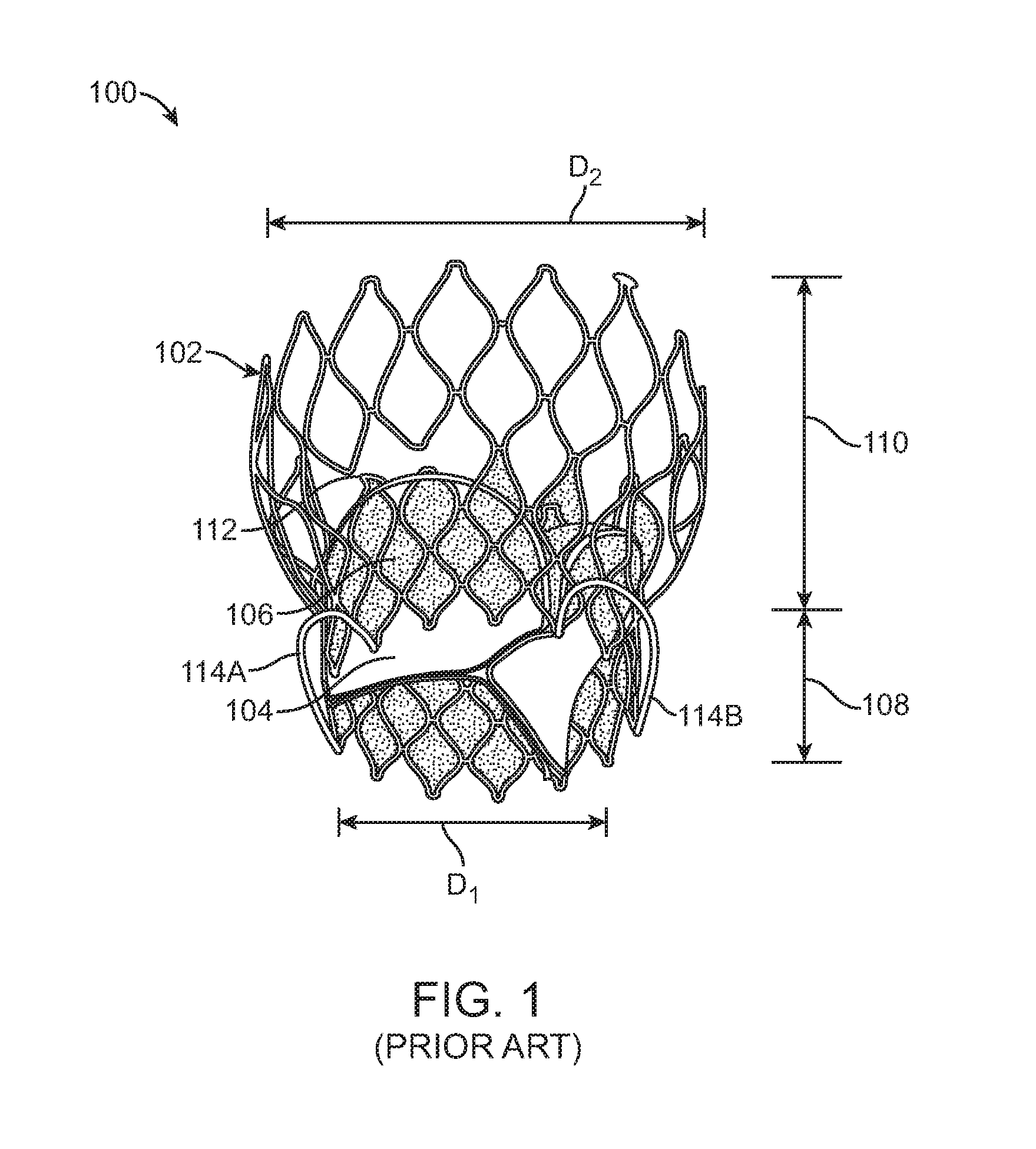 Transcatheter valve prosthesis and a concurrently delivered sealing component