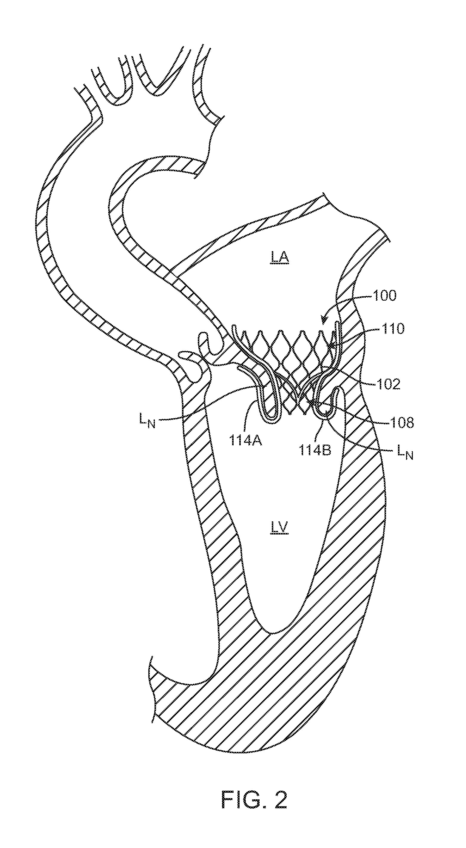Transcatheter valve prosthesis and a concurrently delivered sealing component